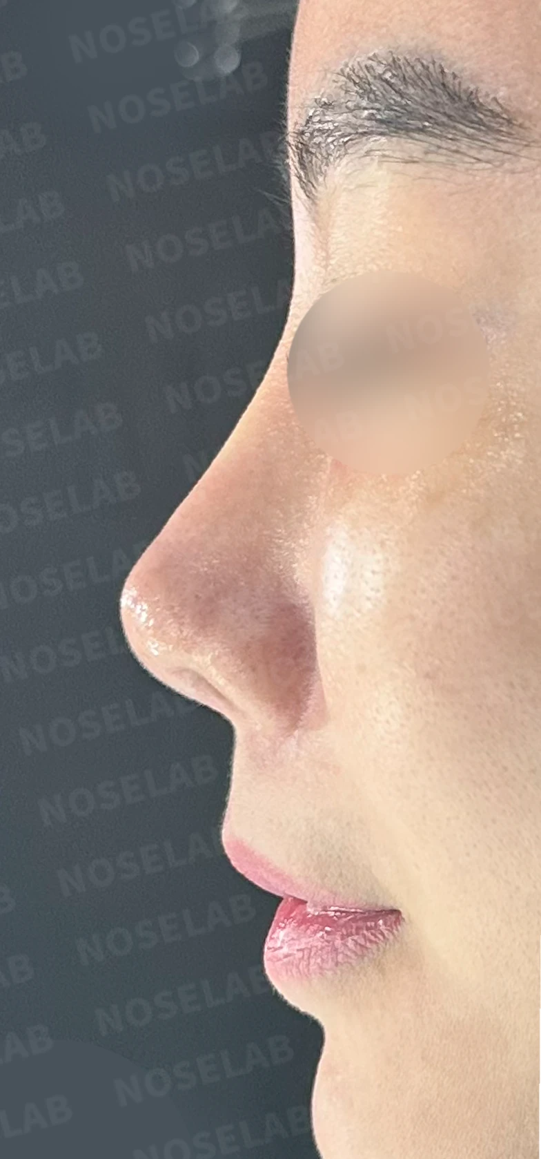 이식한 진피가 반복해서 흡수되는 이유, 재건은 어떻게 하나 — 수술 전 / 수술 직후 0일 직후 사진은 부기가 있는 상태로 최종 결과와 다를 수 있습니다.