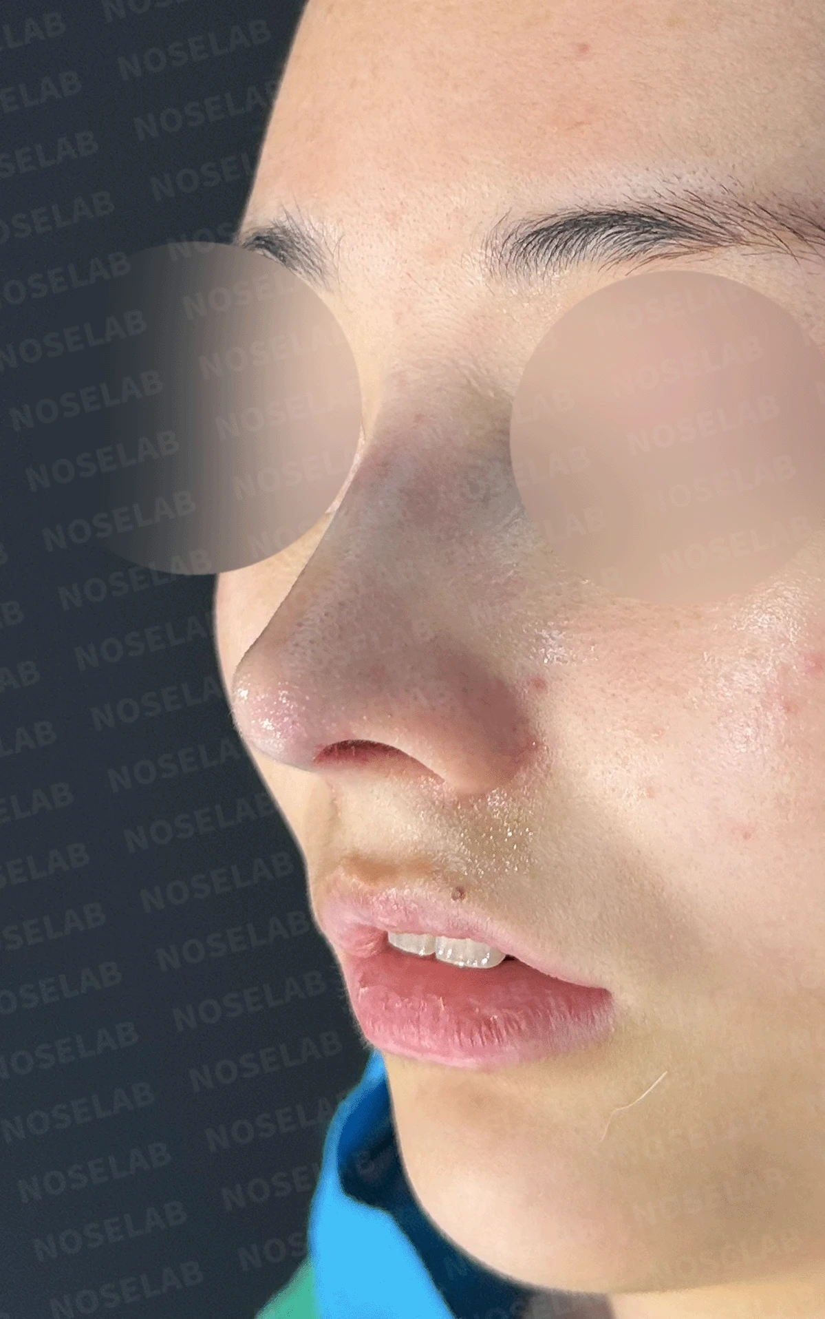 웃을 때만 화살코가 되는 이유와 코끝 연골 교정 방법 — 본문 사진 12