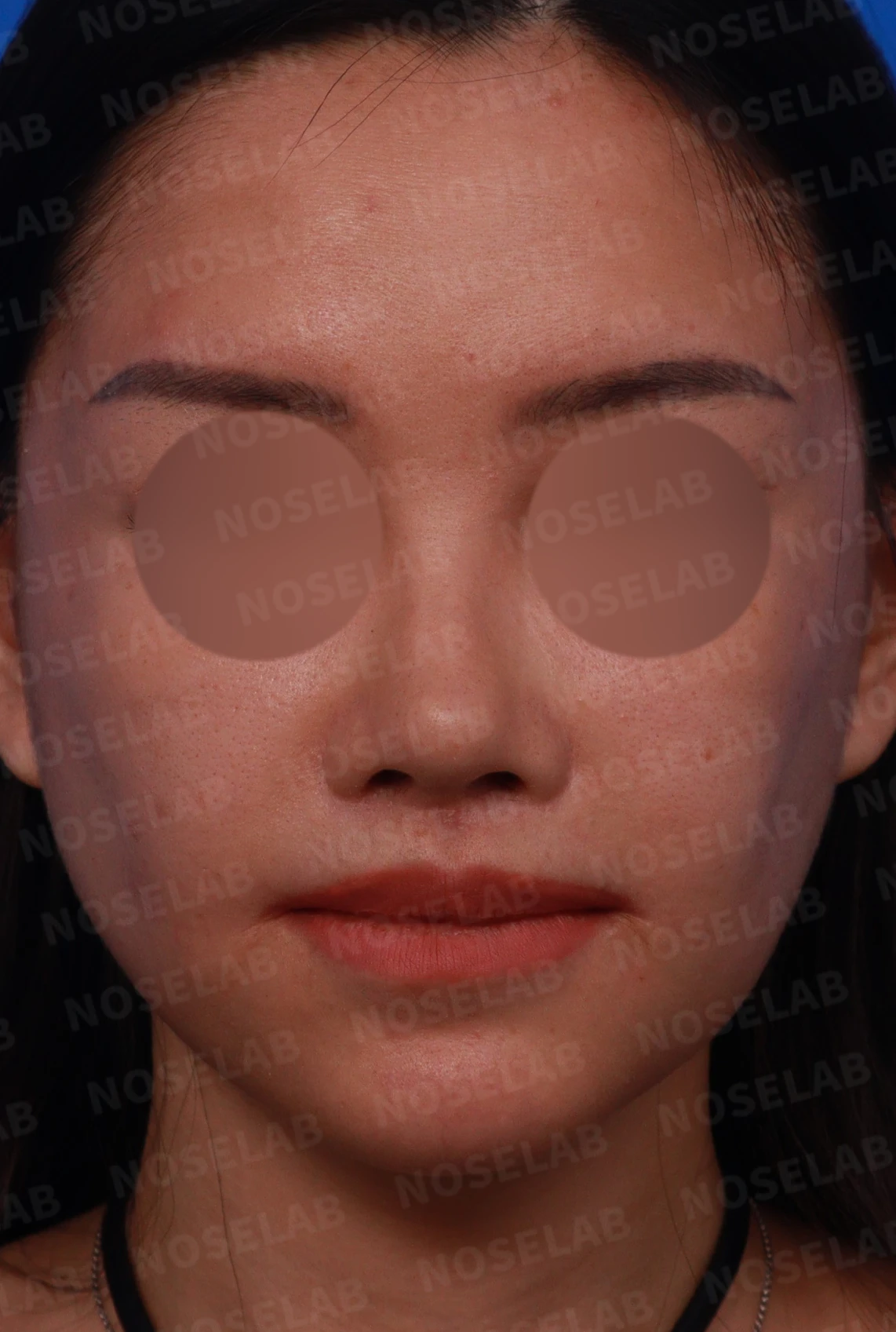 원하는 코 모양과 현재 구조를 함께 살펴보는 수술 계획 — 디자인 상담 정면, 좌측 비스듬한 측면, 측면 사진입니다.