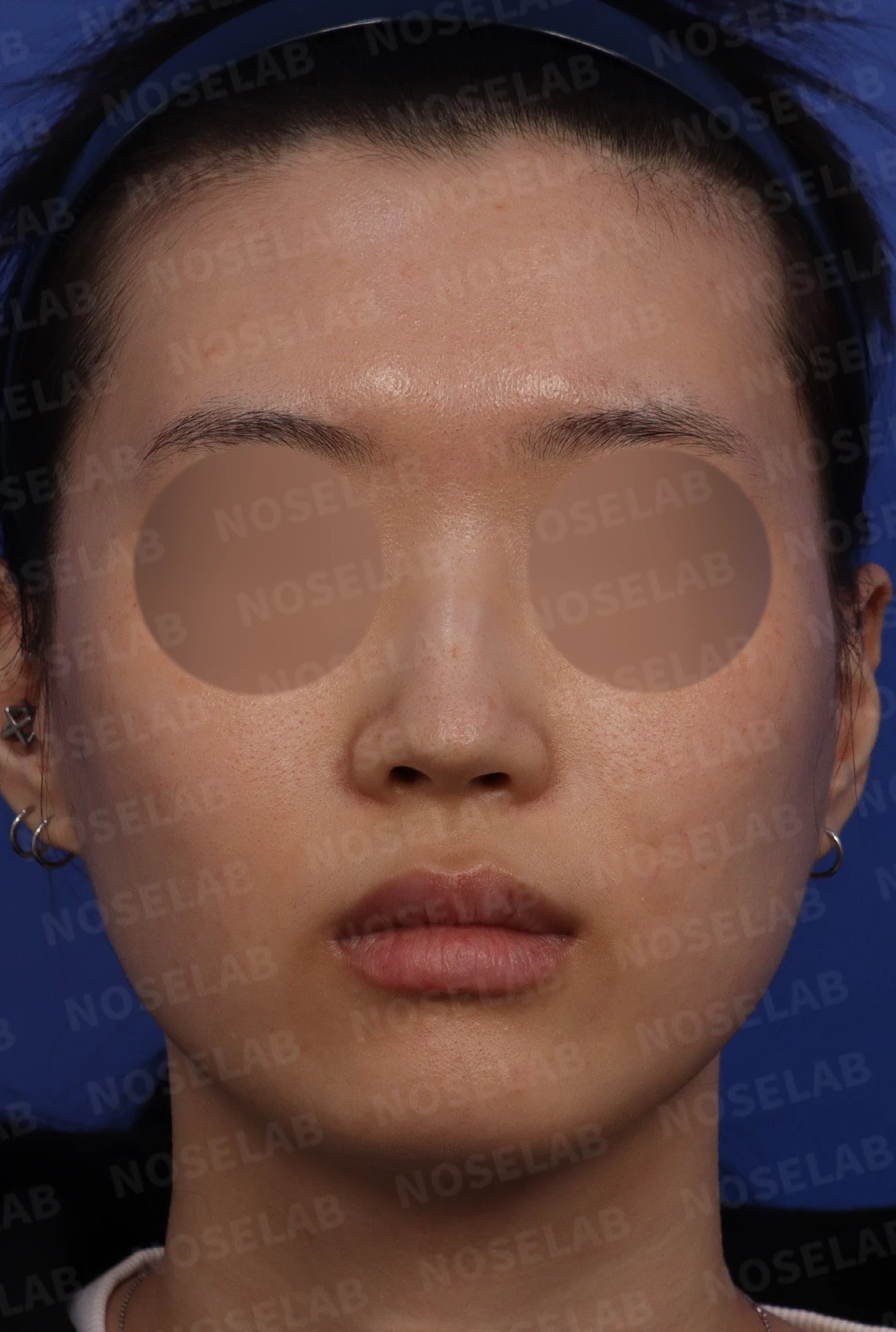 매부리코에 코의 휨과 비공 비대칭이 함께 오는 이유, 비중격 연골 교정은 어떻게 하나 — 디자인 상담 정면, 좌측 측면, 비스듬한 측면 사진