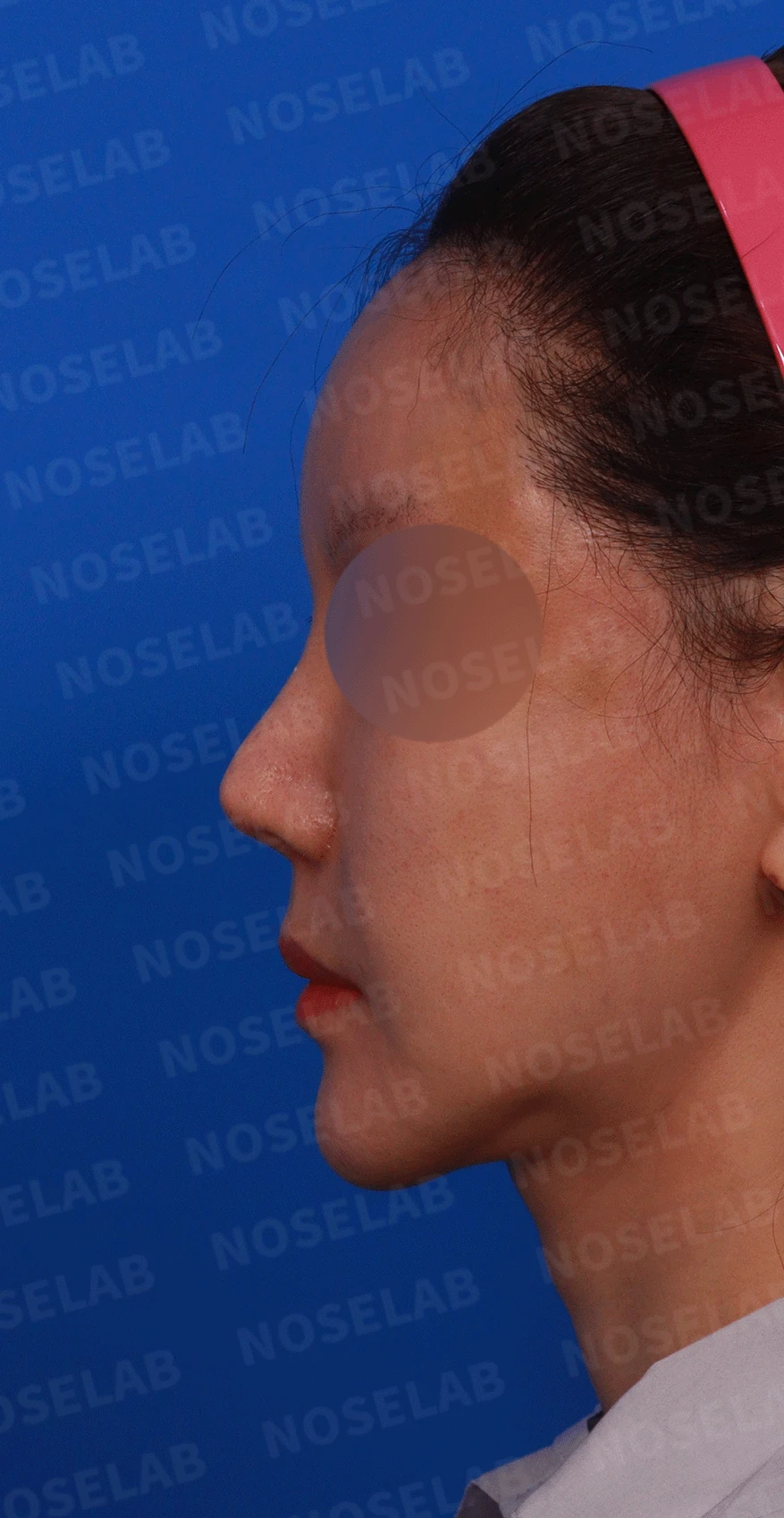 여러 차례 재수술로 코에 쓸 연골이 남지 않았을 때, 재건은 어떻게 하나 — 디자인 상담 정면 , 좌측 비스듬한 측면 , 측면 사진 입니다.