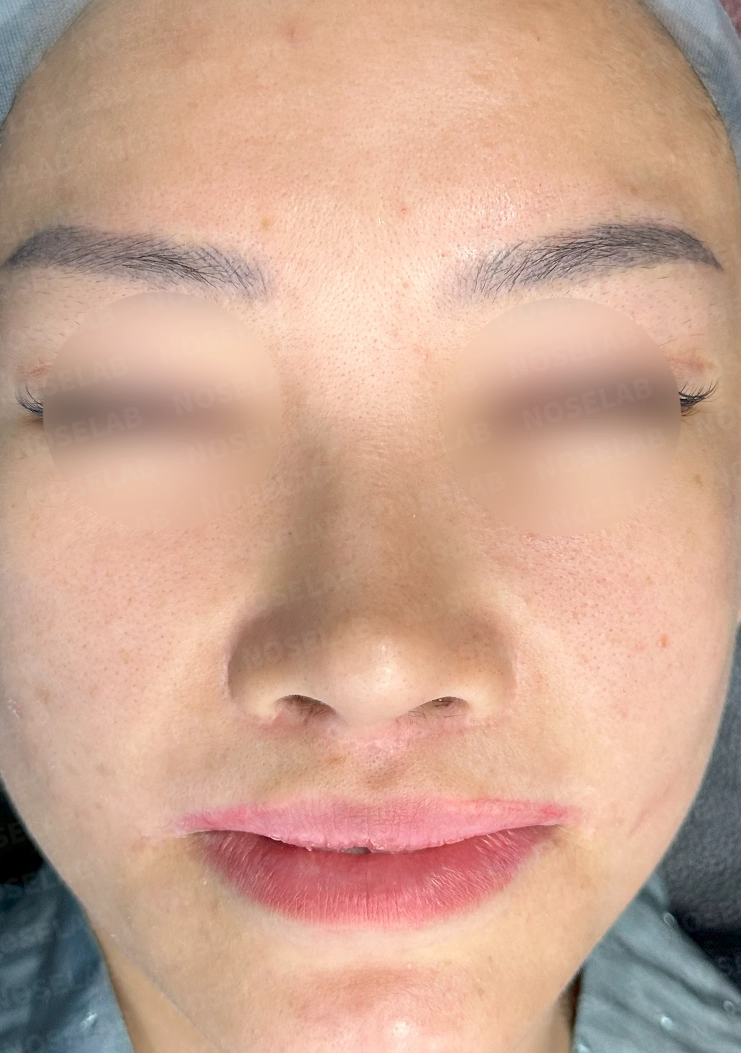 원하는 코 모양과 현재 구조를 함께 살펴보는 수술 계획 — 수술 전 / 수술 직후 0일 직후 사진은 부기가 있는 상태로 최종 결과와 다를 수 있습니다.