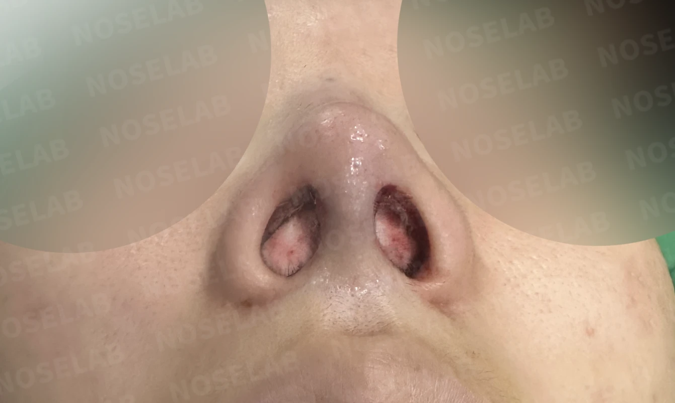 들린 코와 돌출입 개선, 자가늑연골로 화려한 직반라인 완성 — 수술직후 비공 사진입니다.