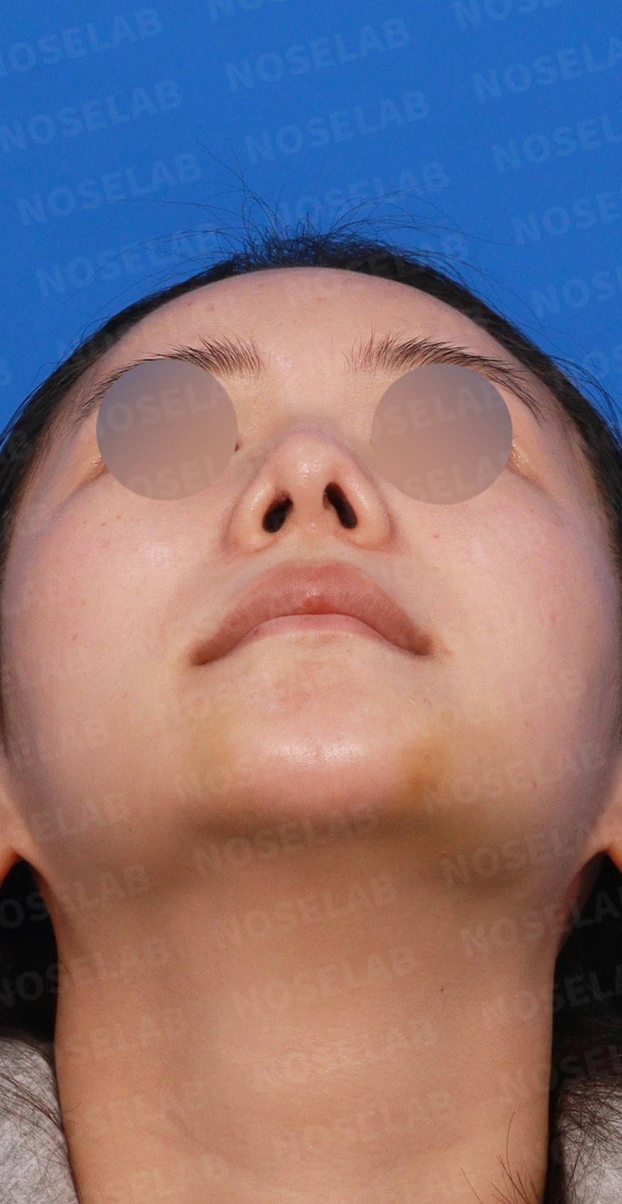 들린 코와 한쪽만 찝힌 콧구멍이 생기는 이유, 무보형물 재건은 어떻게 하나 — 디자인 상담 우측 측면, 비스듬한 측면, 비공 사진입니다.