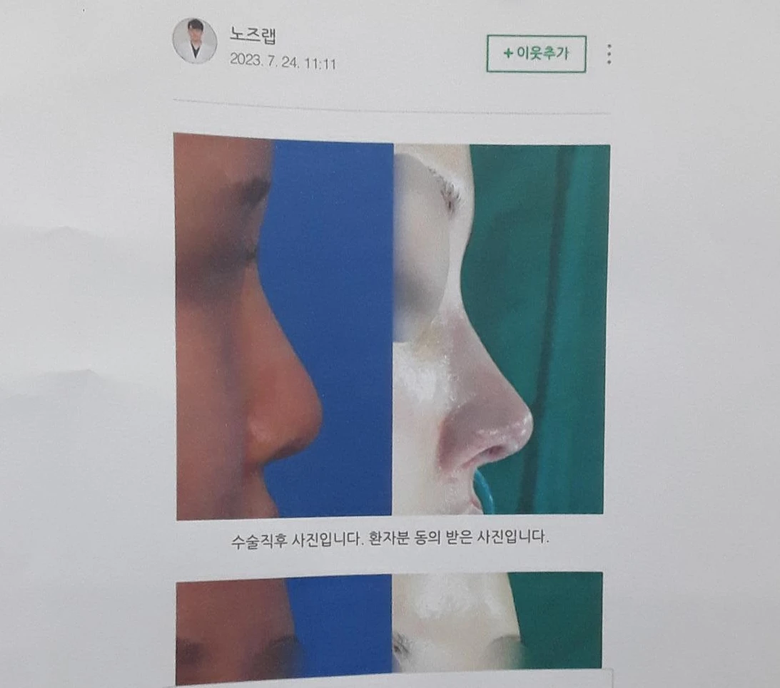 뭉툭하게 퍼진 코끝이 생기는 이유, 자가 늑연골 비중격 연장으로 직반 라인을 만드는 방법 — 본문 사진 8