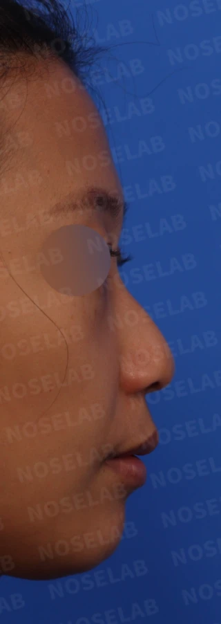 갈라져 보이는 코끝의 구조와 교정 방법 — 본문 사진 5