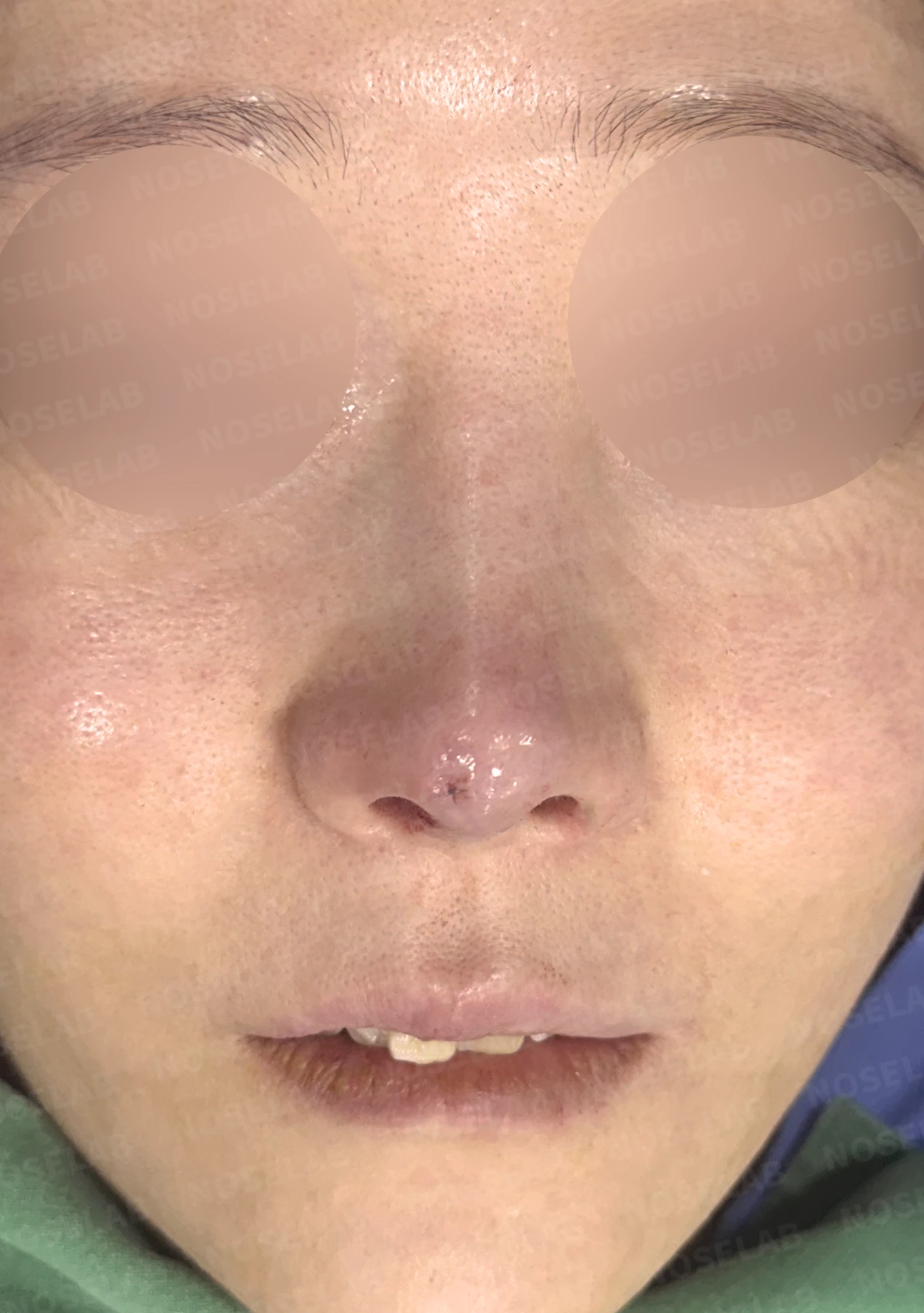 코끝 피부 함몰과 보형물 비침, 자가늑연골로 안전하게 복원한 코재수술 — 전(좌) 직후(우)