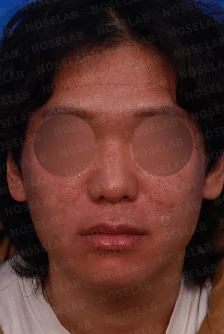 얼굴 비율을 고려한 코성형과 무턱 교정 방법 — 전후 비교