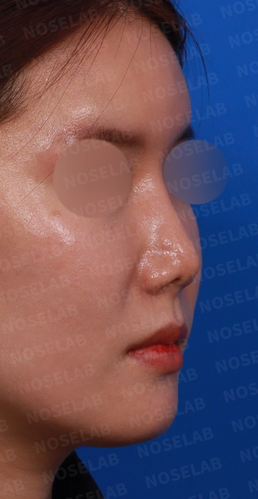 기증 늑연골이 흡수되면 코가 어떻게 변하고, 자가 늑연골 재건은 어떻게 하나 — 디자인 상담 우측 측면 , 비스듬한 측면, 비공 사진