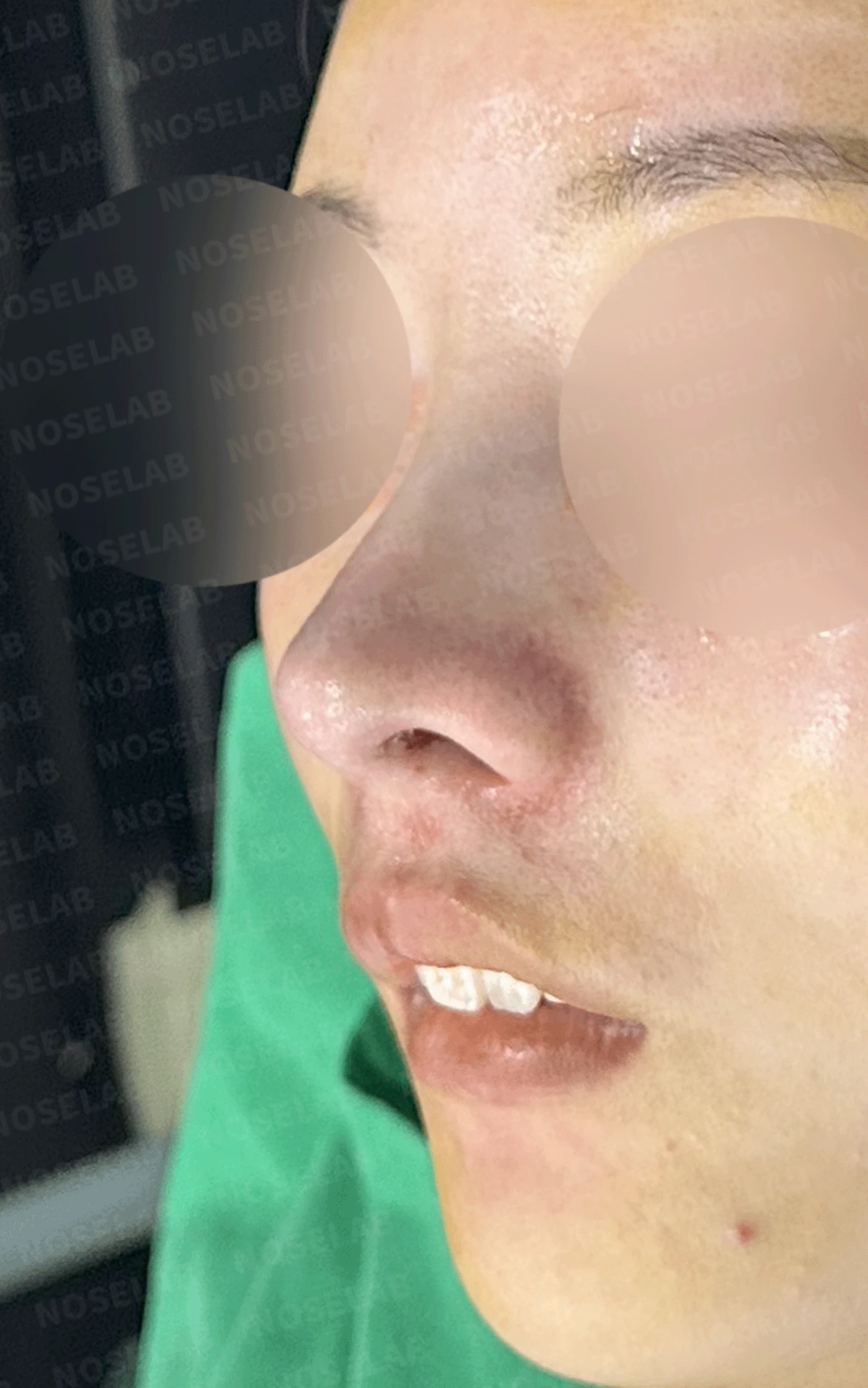 콧대가 인위적으로 보이고 코가 들리는 이유, 재건은 어떻게 하나 — 본문 사진 12