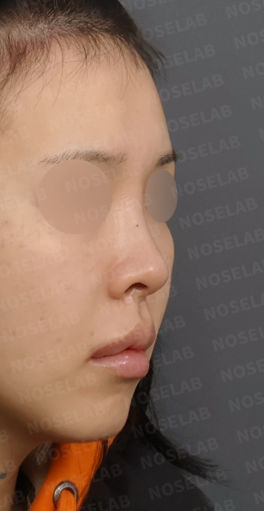 들린 코와 돌출입 개선, 자가늑연골로 화려한 직반라인 완성 — 디자인 상담 우측 측면, 비스듬한 측면, 비공 사진입니다.