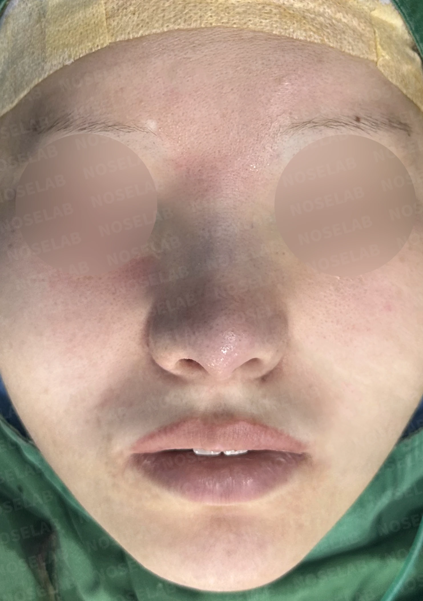복코와 들린 코끝, 자가늑연골로 여성스러운 직반라인 완성 — 전(좌) 직후(후)