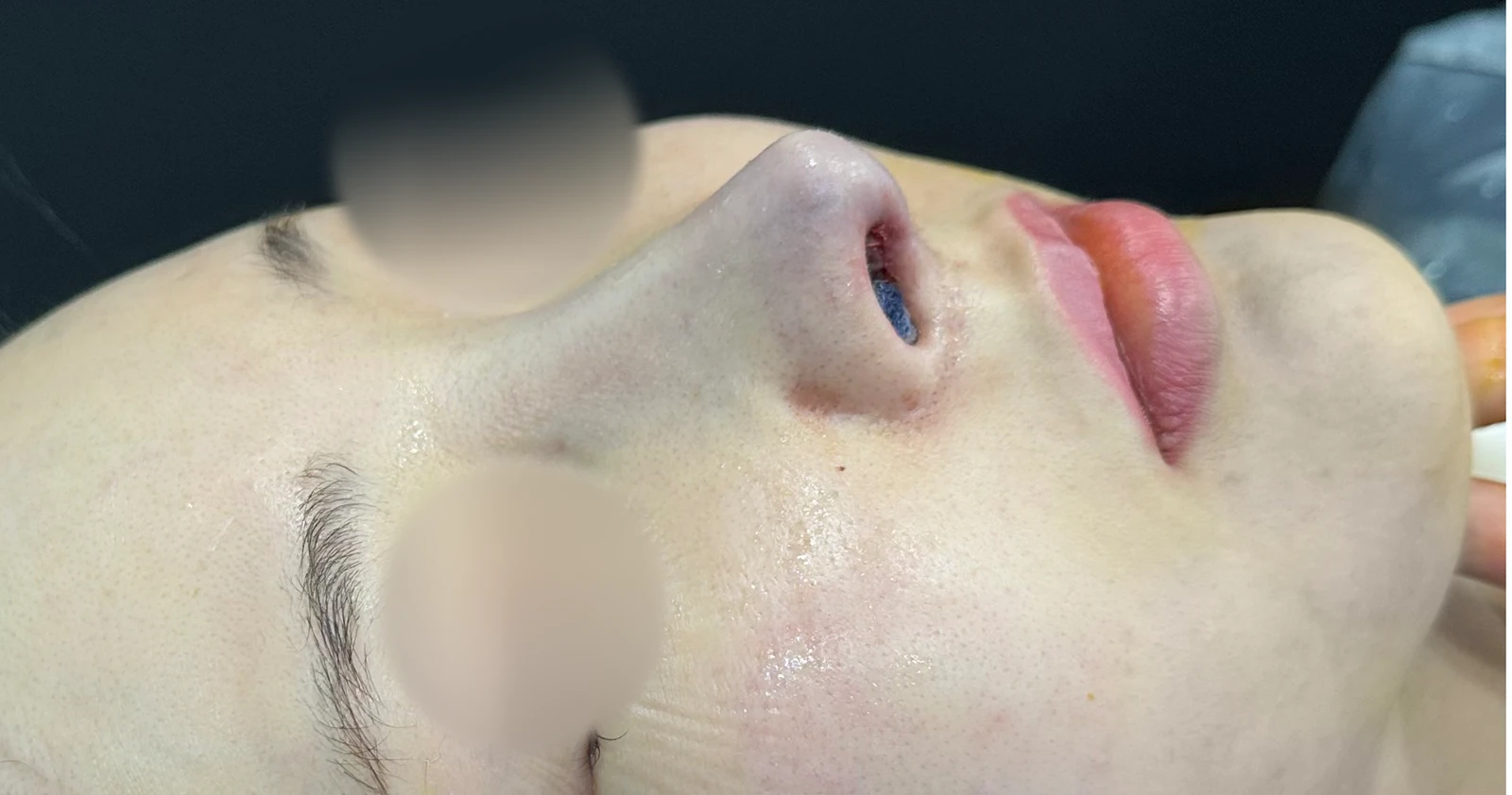 수술 후 14일 조기 교정에서 확인할 점 — 수술 전 / 수술 직후 0일 직후 사진은 부기가 있는 상태로 최종 결과와 다를 수 있습니다.