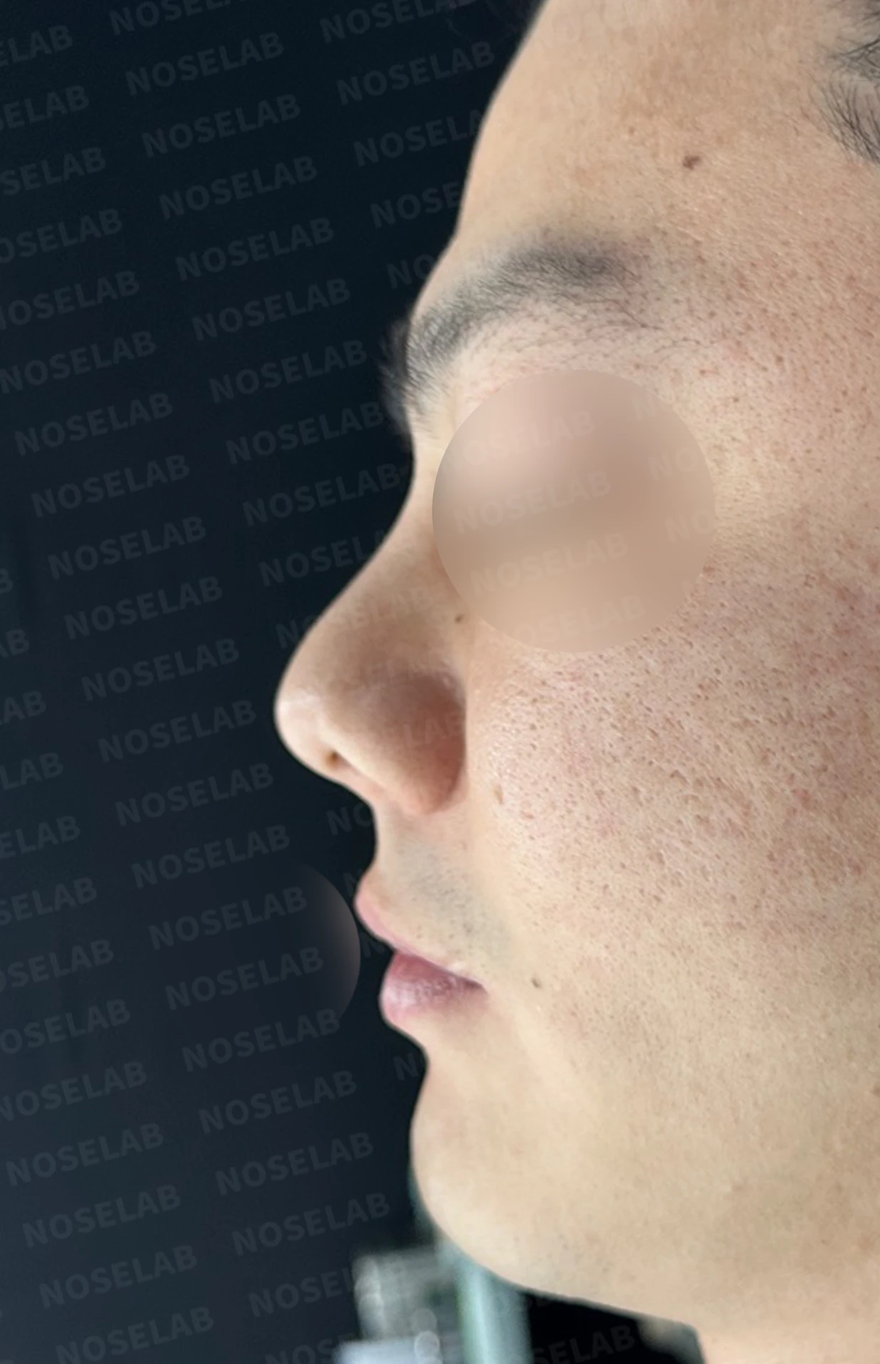 콧구멍 비대칭과 들린 코가 함께 생기는 이유, 늑연골 재건은 어떻게 하나 — 수술 전 / 수술 직후 0일 직후 사진은 부기가 있는 상태로 최종 결과와 다를 수 있습니다.
