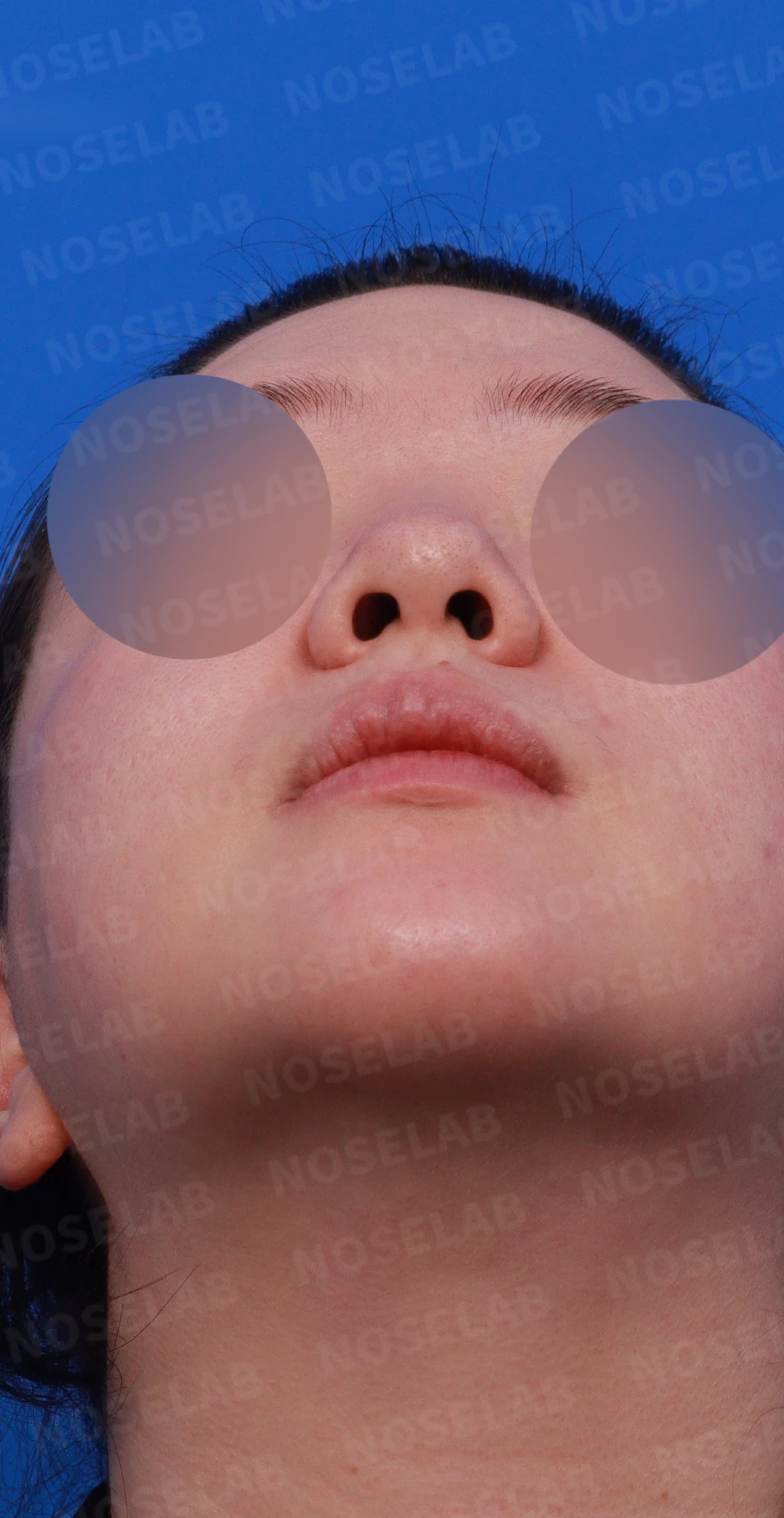 코끝이 퍼지고 입체감이 없어 보이는 이유, 복코 교정은 어떻게 하나 — 디자인 상담 우측 측면, 비스듬한 측면 사진, 비공 사진
