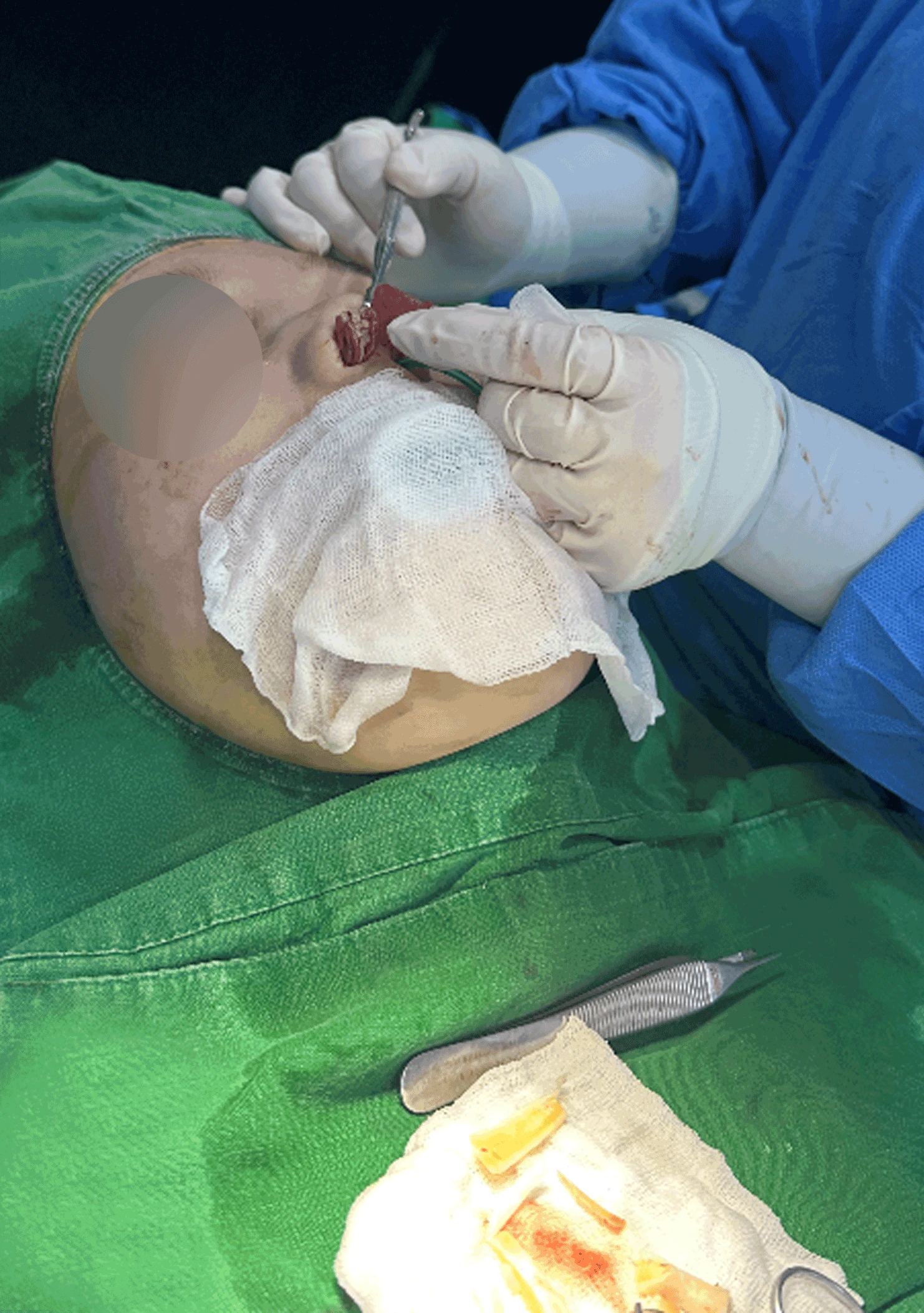 오래된 코성형 뒤 코끝이 들리고 콧구멍이 드러나는 이유, 제거와 자가진피 재건은 어떻게 하나 — 수술 중 메드포어 제거 사진.