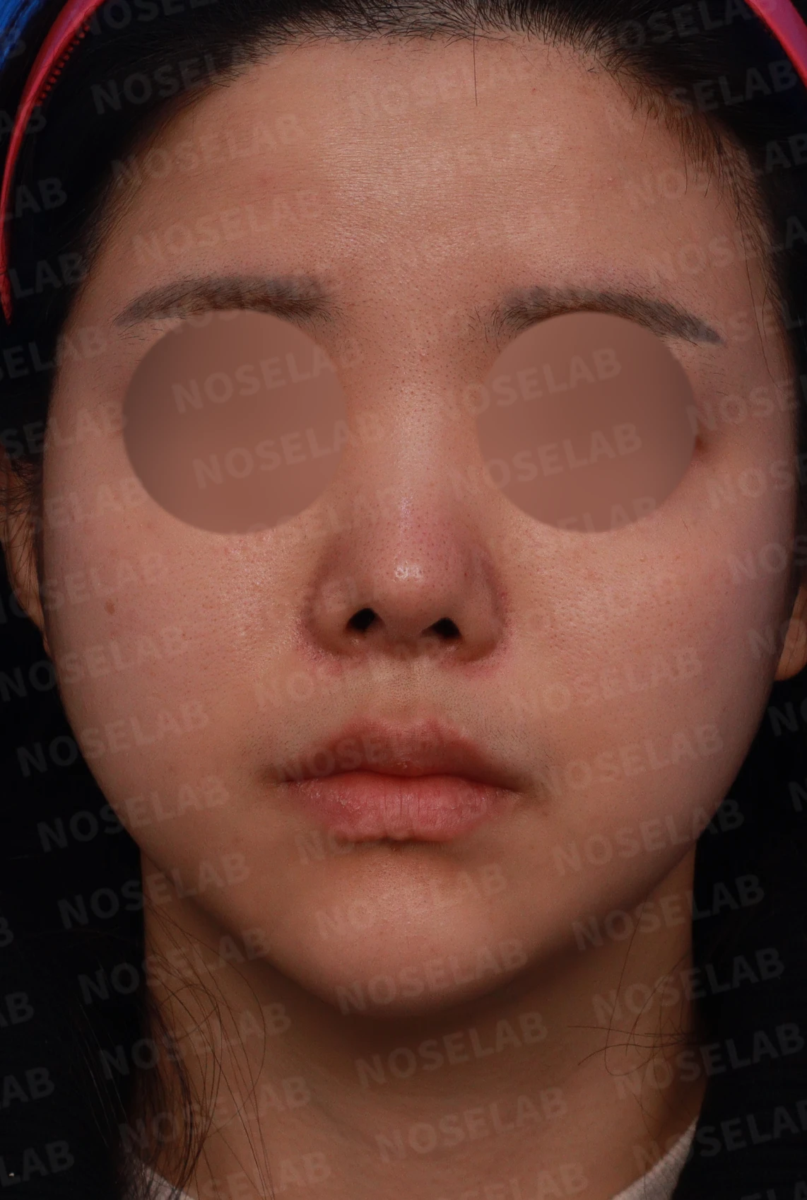 퍼진 콧대와 들린 코끝은 왜 생기나, 늑연골 재건은 어떻게 하나 — 디자인 상담 정면, 좌측 측면, 비스듬한 측면 사진