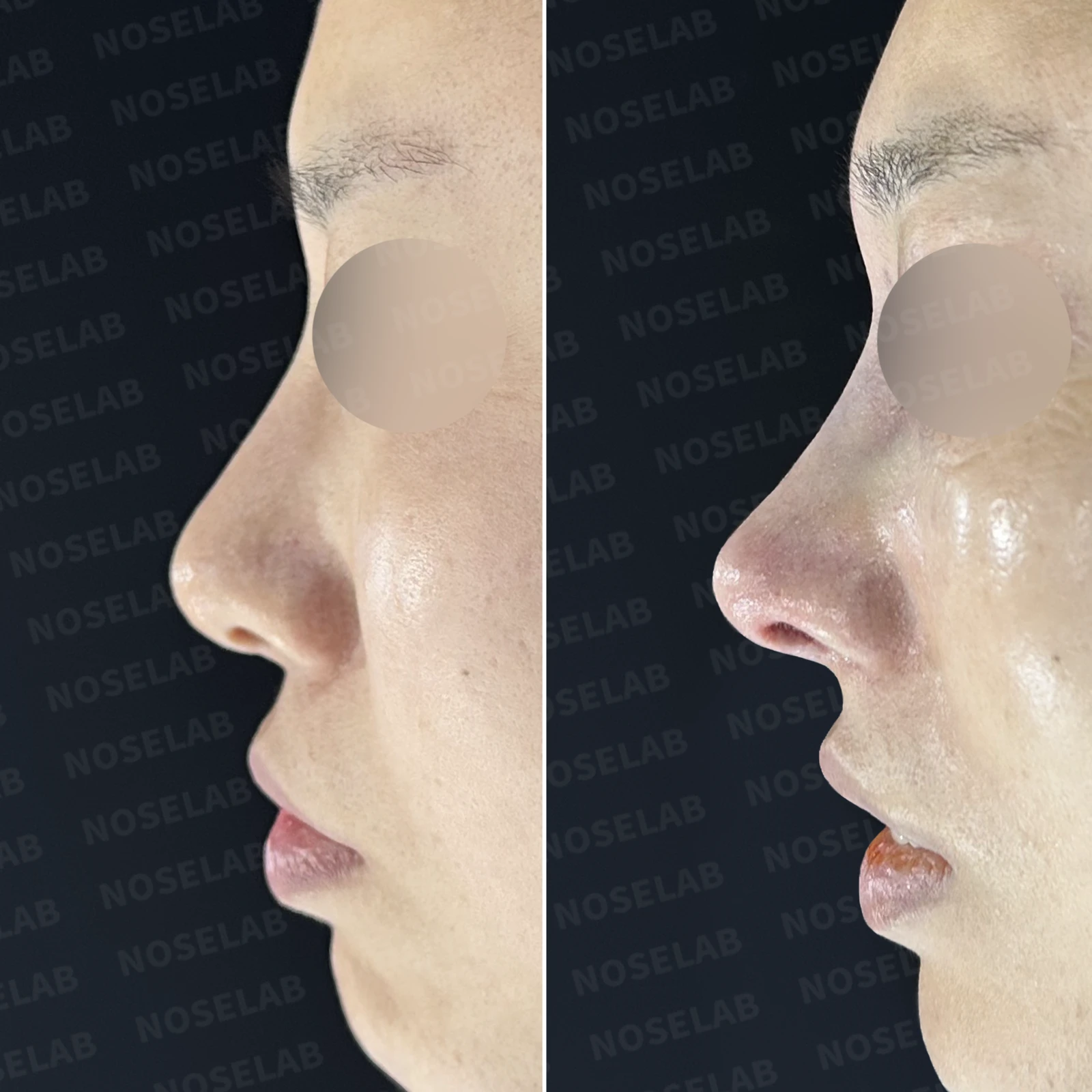비공 비대칭과 휘어진 코, 자가늑연골 재건으로 교정한 코재수술 — 본문 사진 21