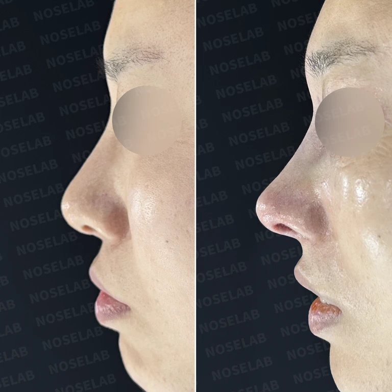 비공 비대칭과 휘어진 코, 자가늑연골 재건으로 교정한 코재수술 — 전후 비교