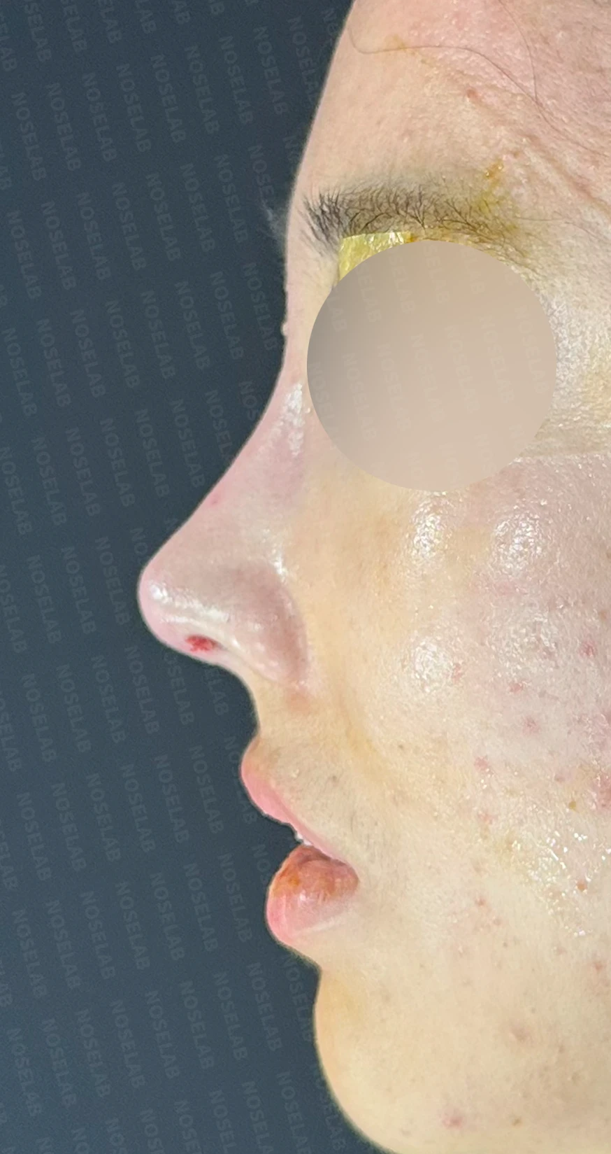 코필러 제거, 코막힘 해결 사례 — 직후 정면, 비스듬한 측면, 측면 사진입니다.