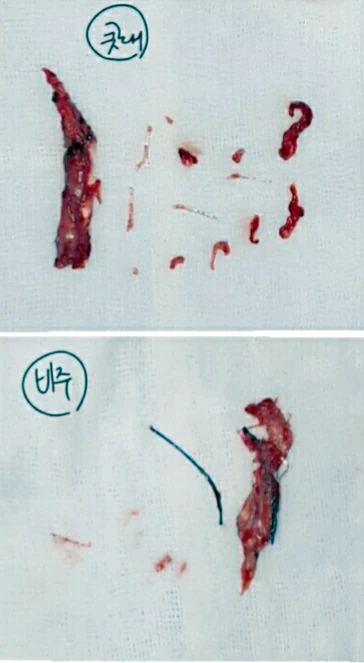 이물질제거후 코성형 방법 — 본문 사진 5