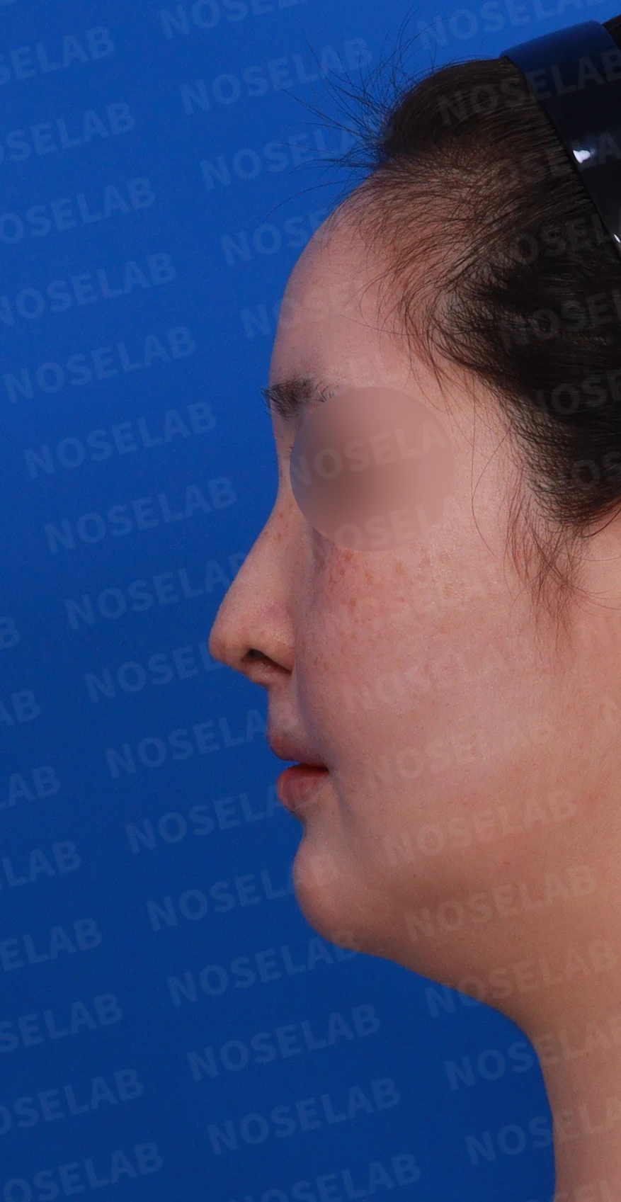 구순구개열에서 코 비대칭이 남는 이유와 늑연골·귀연골 재건 방법 — 디자인 상담 정면 , 좌측 비스듬한 측면 , 측면 사진입니다.