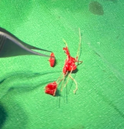 퍼진 콧대와 들린 코끝은 왜 생기나, 늑연골 재건은 어떻게 하나 — 제거된 이물질 사진
