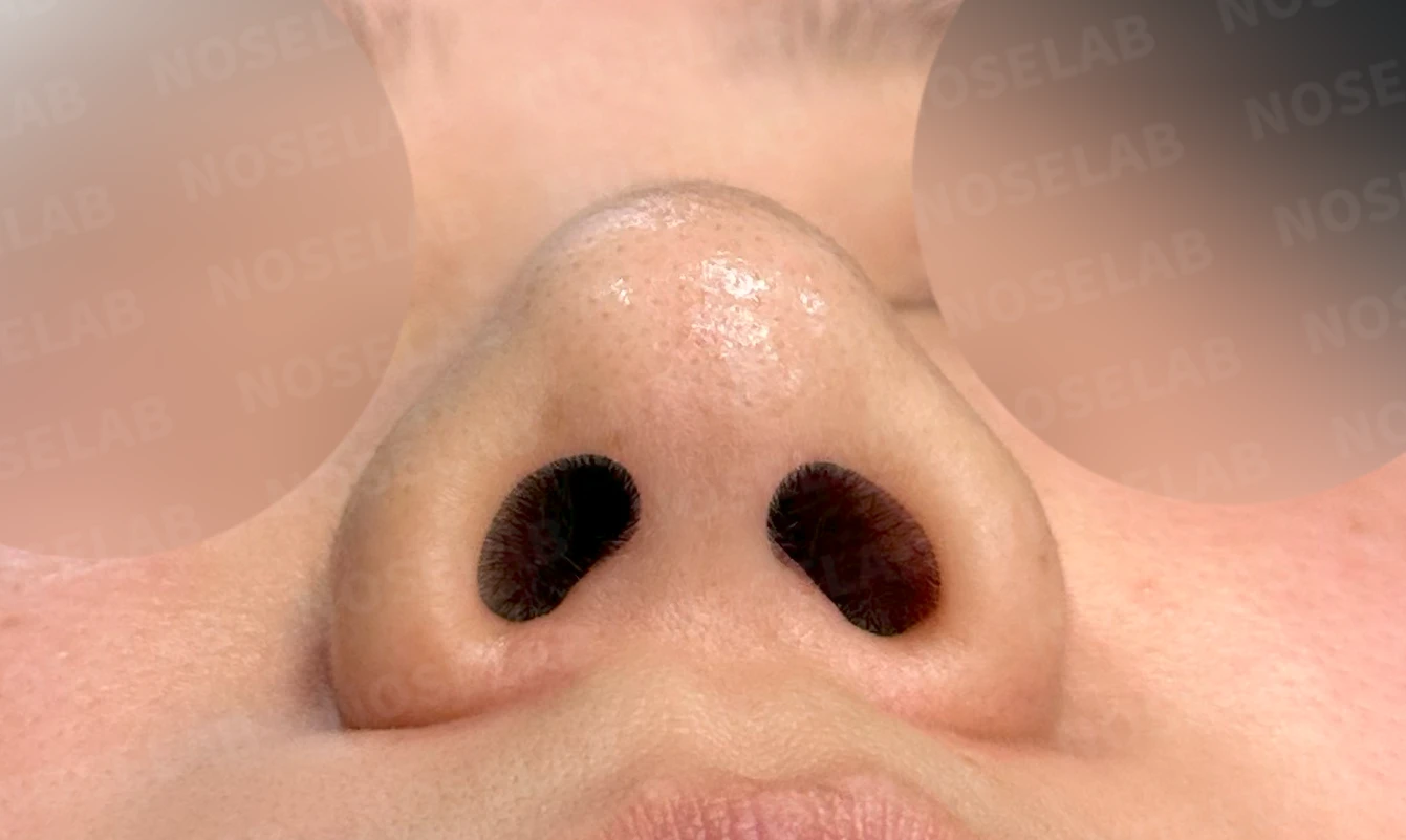 코뼈 비대칭과 처진 코끝에 만성 비염이 겹칠 때 보는 것 — 수술 전 / 수술 직후 0일 직후 사진은 부기가 있는 상태로 최종 결과와 다를 수 있습니다.