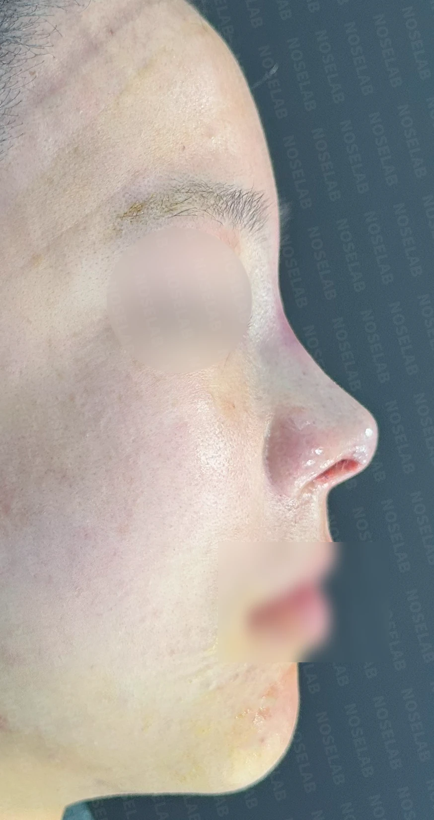 이물질제거후 코성형 방법 — 수술 직후 0일 정면, 비스듬한 측면, 측면 직후 사진은 부기가 있는 상태로 최종 결과와 다를 수 있습니다.