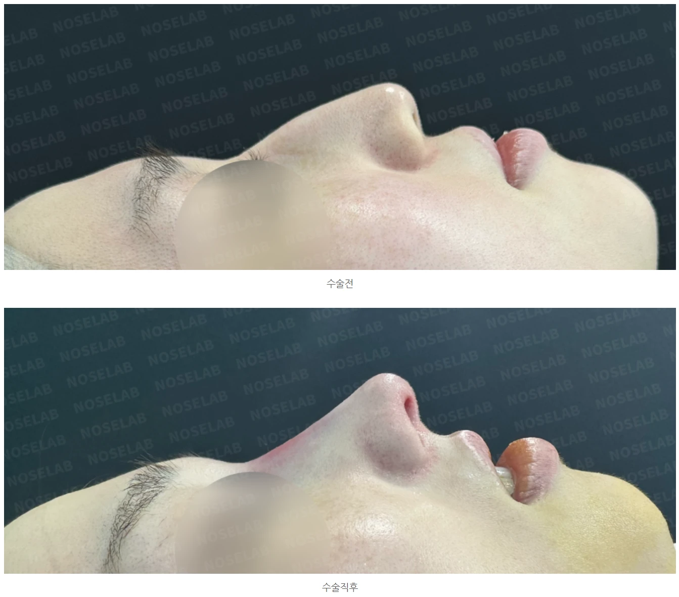 이물질(메쉬·실) 제거후 코성형 방법 — 본문 사진 19