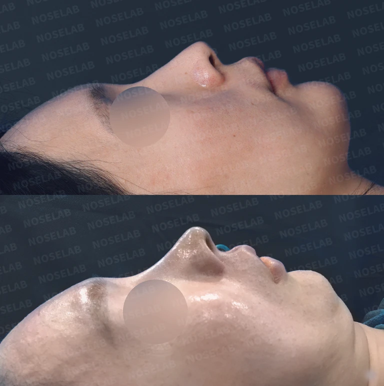 코를 부딪힌 후 생긴 코막힘, 이비인후과 전문의의 맞춤 솔루션 — 전후 비교
