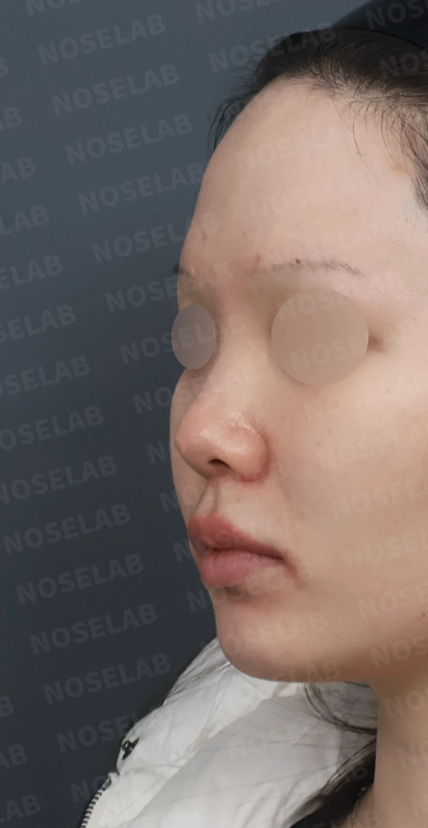 복코와 들린 코끝, 자가늑연골로 여성스러운 직반라인 완성 — 디자인 상담 정면, 좌측 측면, 비스듬한 측면 사진입니다.