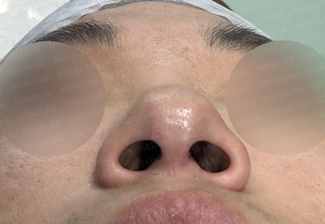 휜코 교정하면 안면 비대칭이 좋아질까요? — 수술 전 / 수술 직후 0일 직후 사진은 부기가 있는 상태로 최종 결과와 다를 수 있습니다.