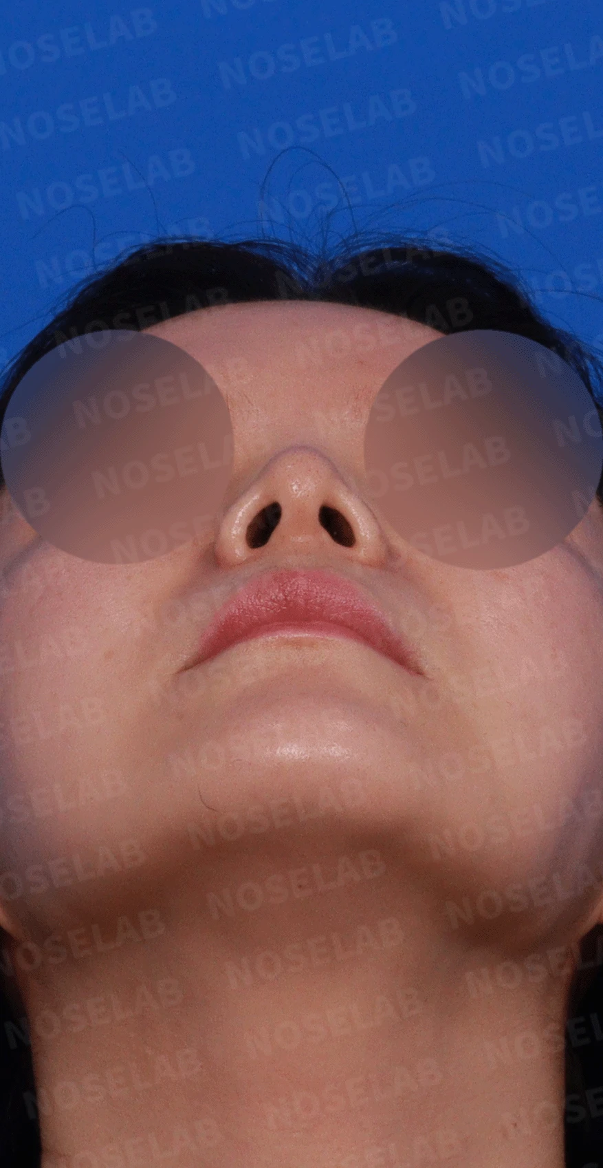 늑연골 석회화를 미리 확인해야 하는 이유와 휜코·짧은코 교정 방법 — 디자인 상담 우측 측면 , 비스듬한 측면 , 비공 사진