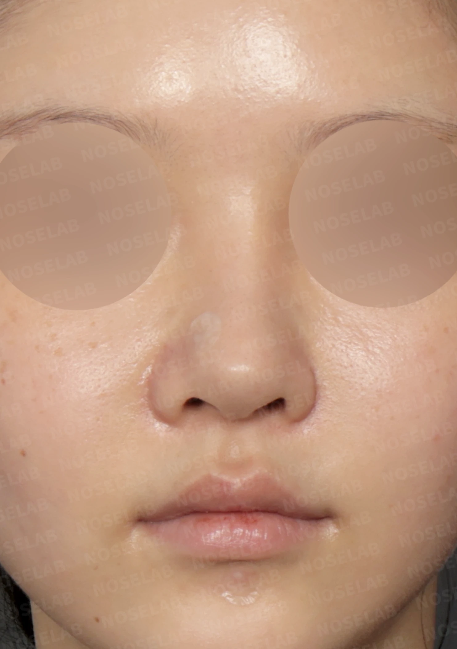 휘어진 코와 복코, 자가늑연골 비중격 재건으로 안전하게 교정한 코재수술 — 전(좌) , 직후(우)