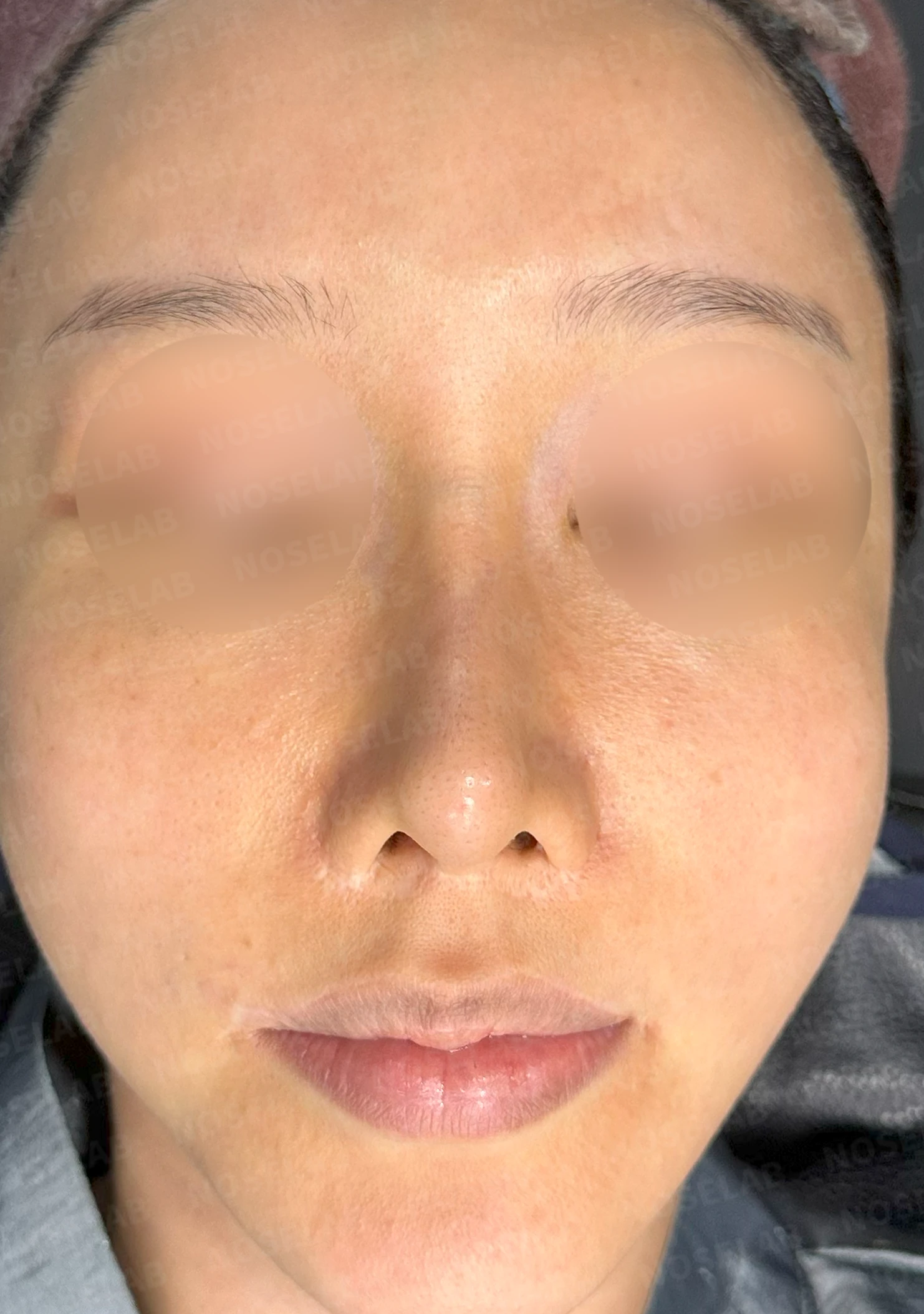 퍼진 코와 중안면부 비율을 고려한 교정 방법 — 수술 전 / 수술 직후 0일 직후 사진은 부기가 있는 상태로 최종 결과와 다를 수 있습니다.