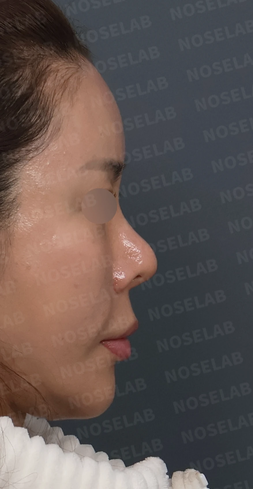 비중격 소실 후 들린 코끝과 찝혀 보이는 콧날개, 자가늑연골로 정밀 재건 — 디자인 상담 우측 측면, 비스듬한 측면, 비공 사진입니다.