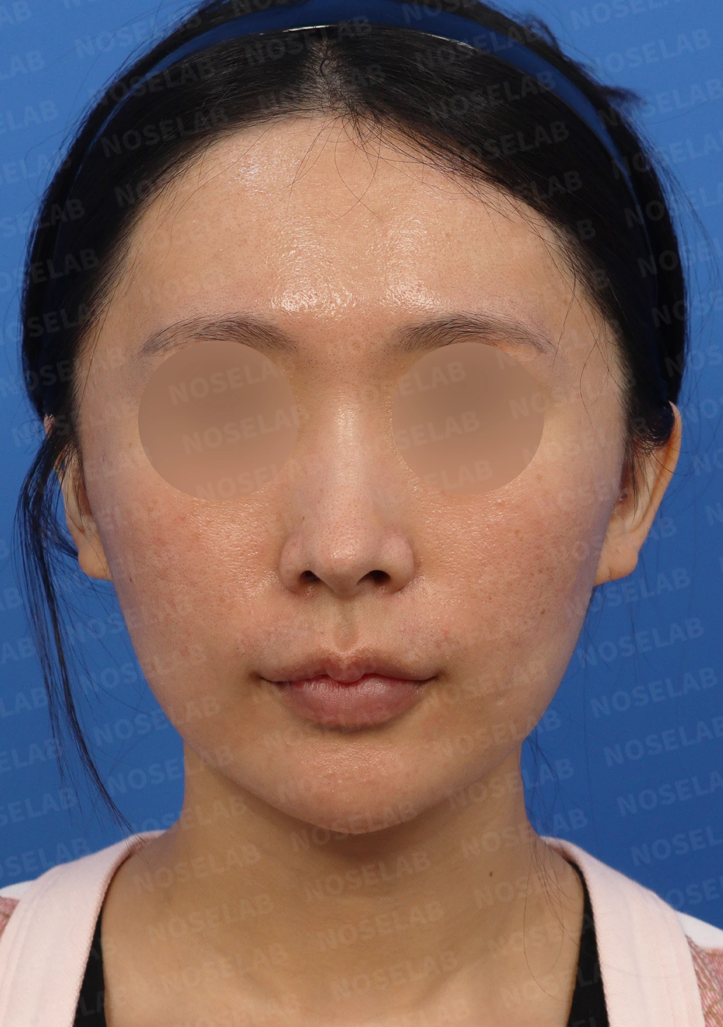 코 외상 후 생긴 코막힘의 구조와 교정 방법 — 수술전 디자인 상담 정면, 비스듬한 측면, 측면
