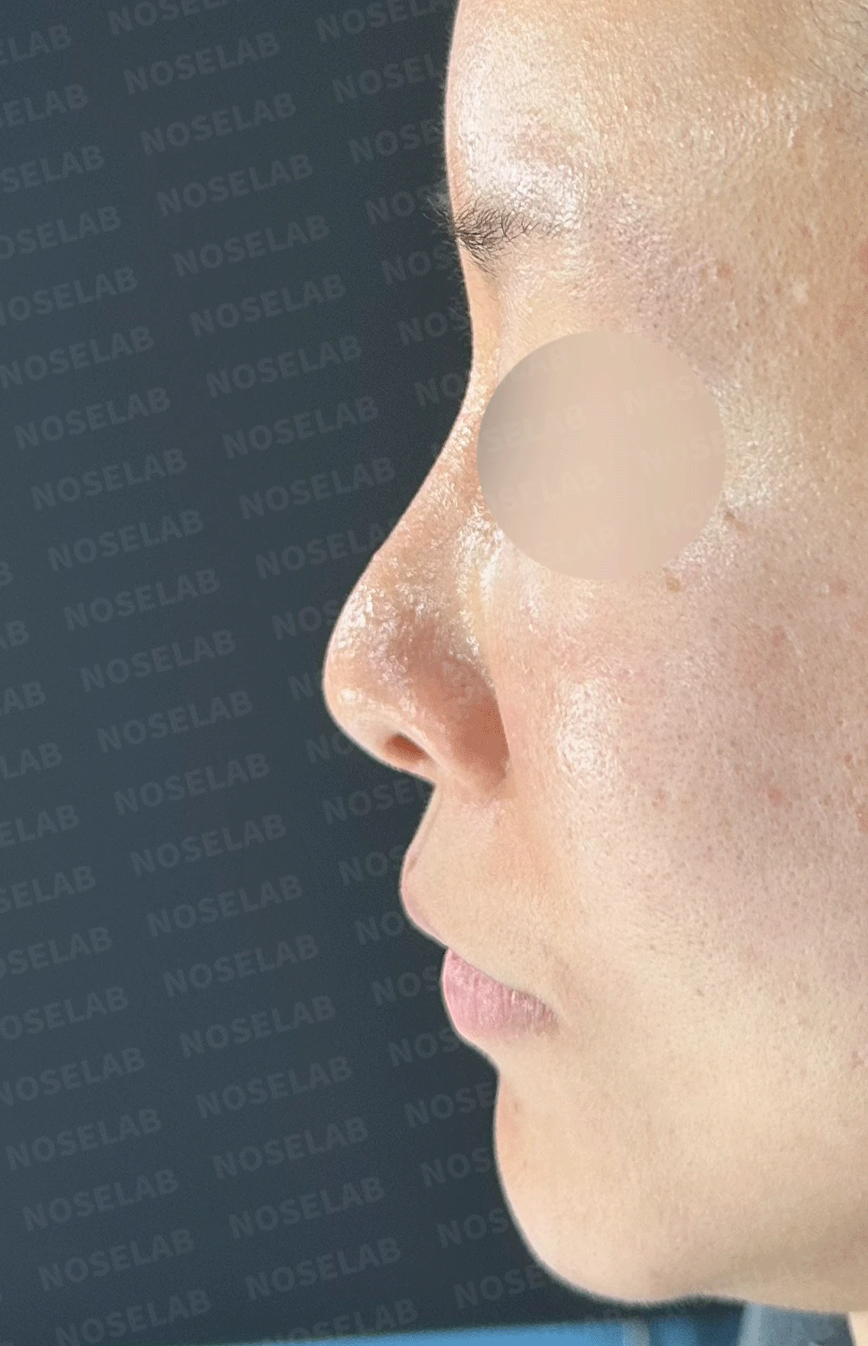 후비루와 코끝 처짐이 함께 나타나는 이유, 비중격 연장과 기능 수술은 어떻게 하나 — 본문 사진 9