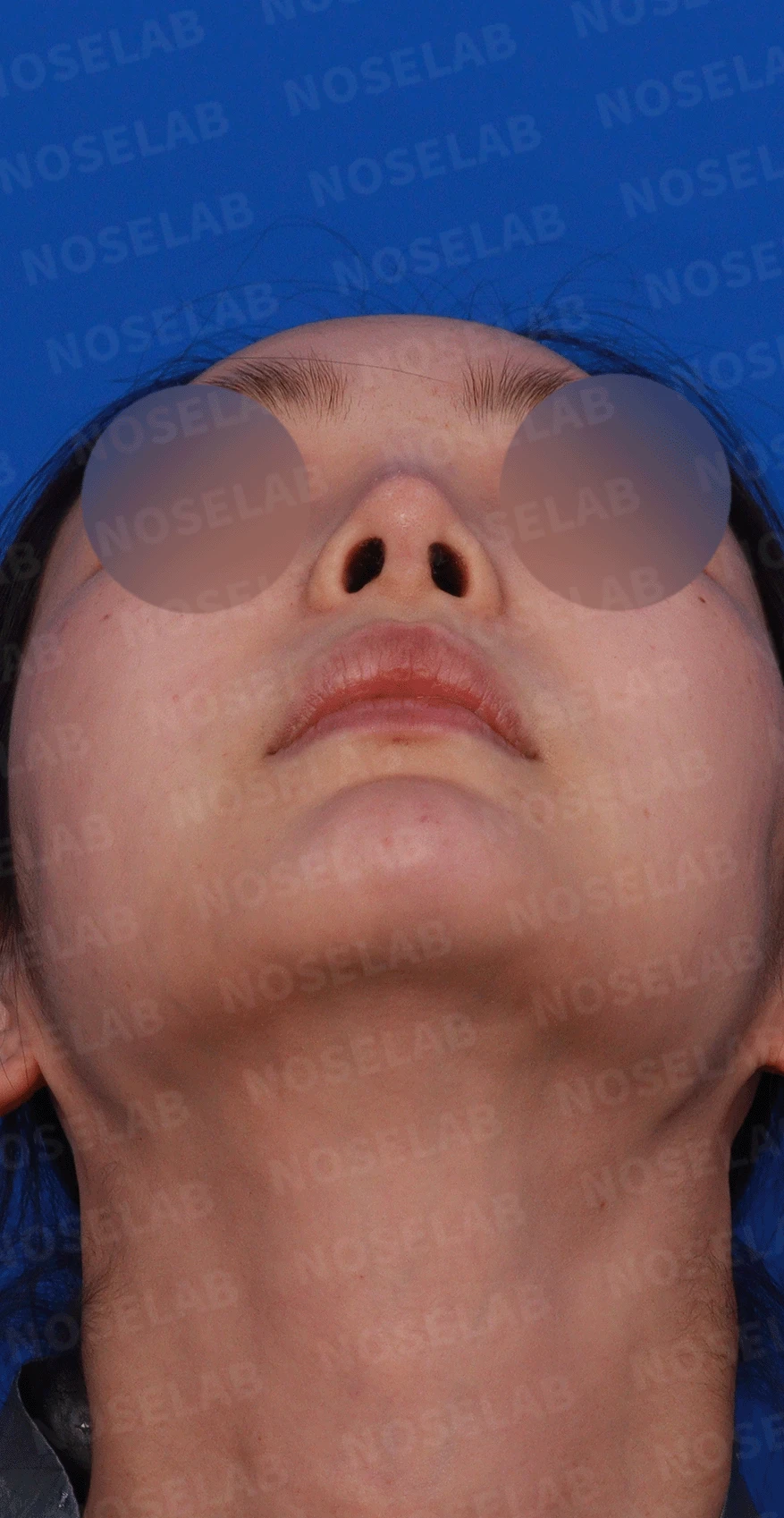 코끝 처짐과 코막힘을 함께 살펴보는 재수술 방법 — 디자인 상담 우측 측면, 비스듬한 측면, 비공 사진입니다.