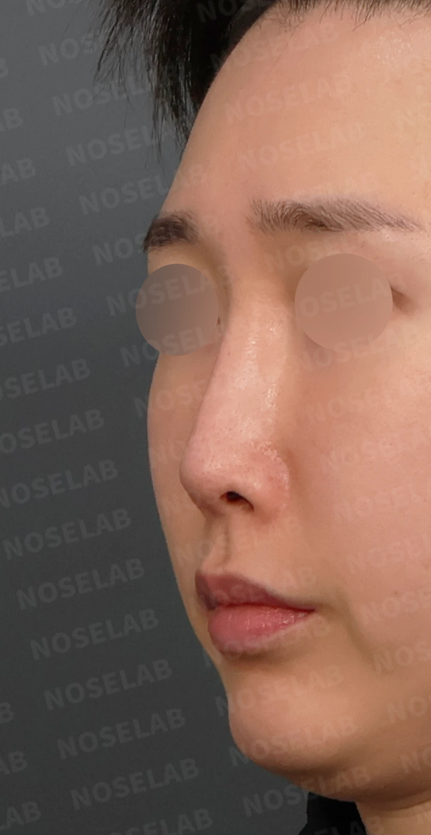 실리콘이 휘고 코가 길어 보이는 이유, 보형물 교체와 늑연골 재건은 어떻게 하나 — 디자인 상담 정면, 좌측 측면, 비스듬한 측면 사진입니다.