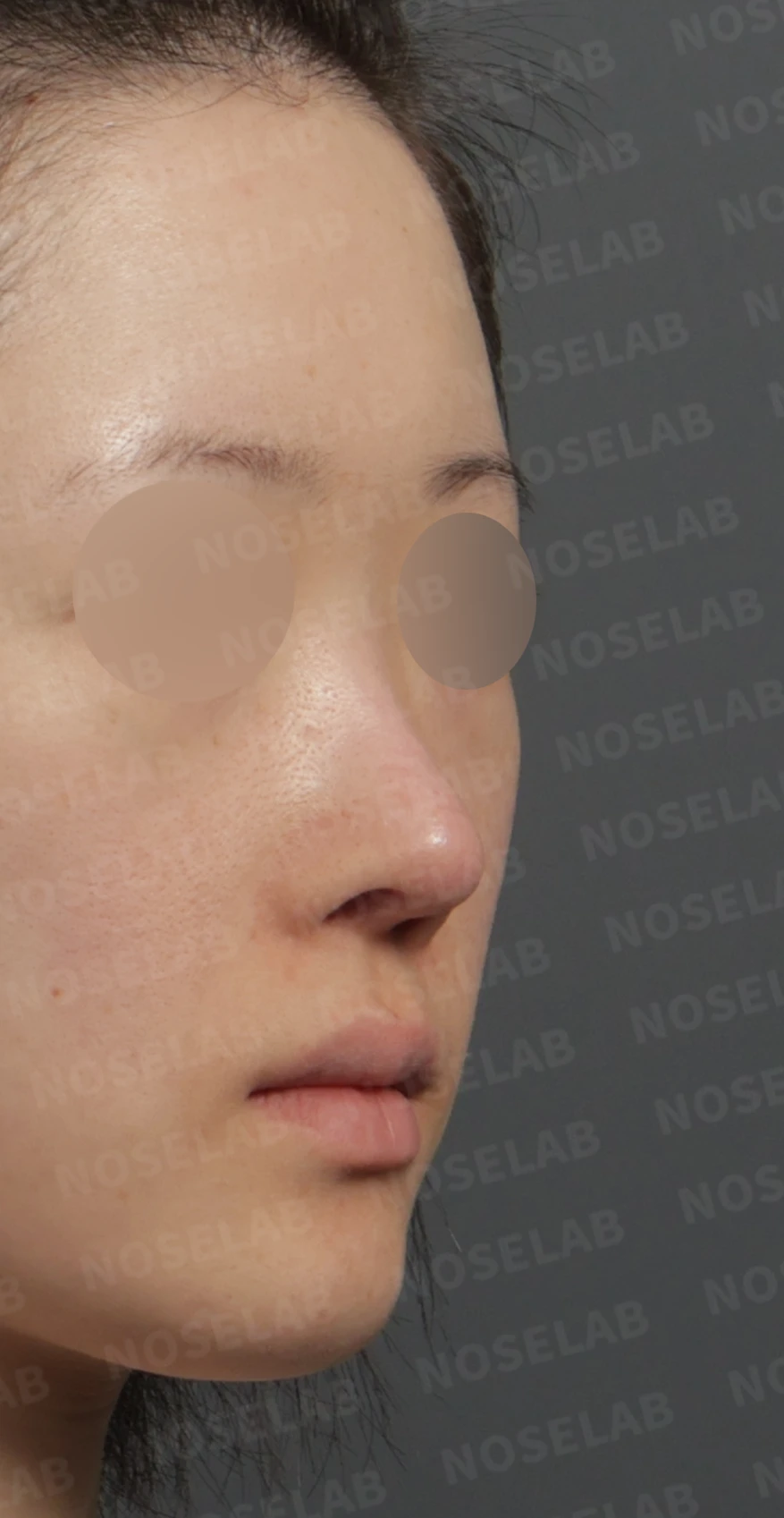 보형물 비침과 들린 코, 자가늑연골로 안전하게 교정한 코재수술 — 디자인 상담 우측 측면 , 비스듬한 측면 , 비공 사진입니다.