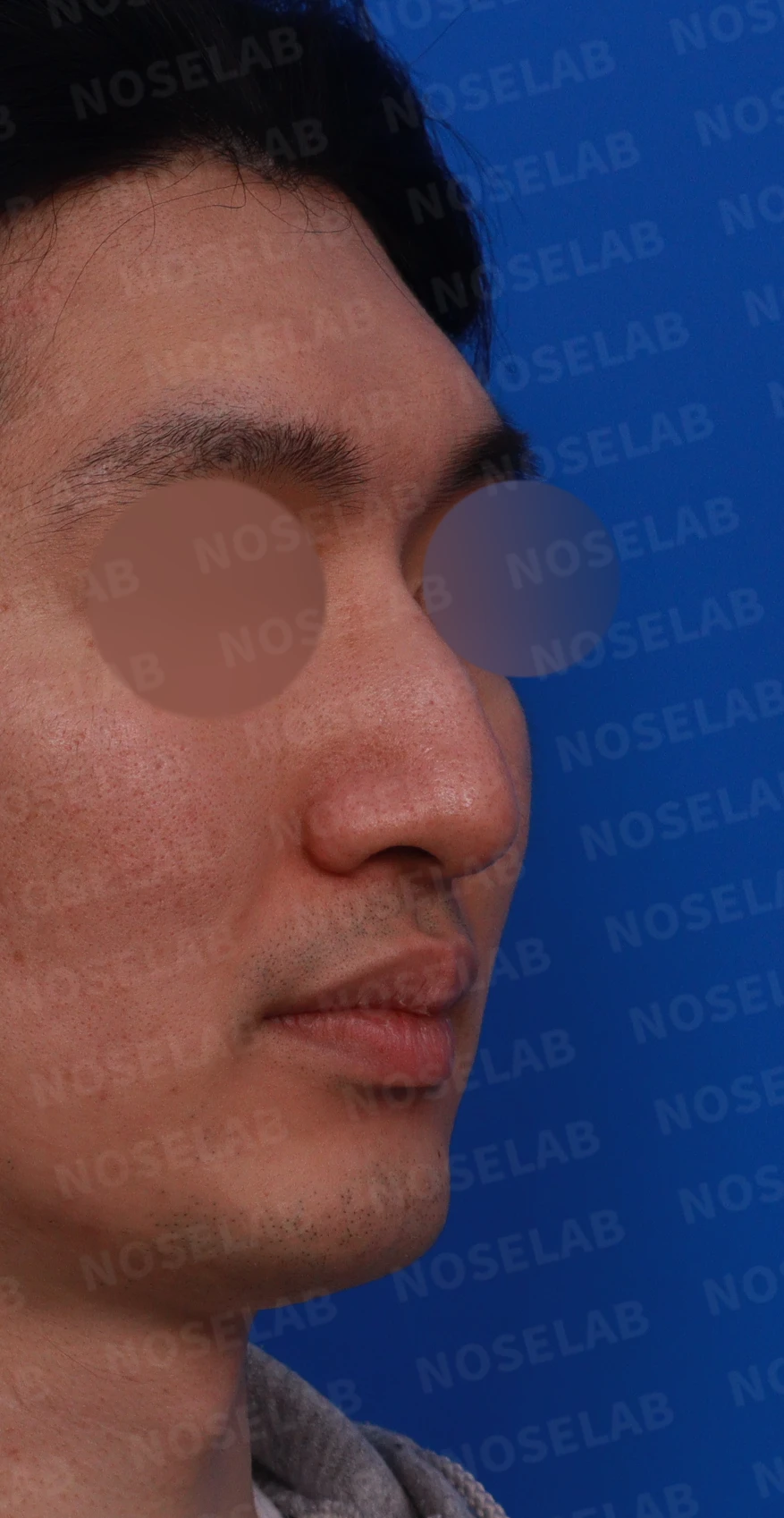 매부리코에 코막힘이 함께 오는 이유, 자가 늑연골만으로 하는 교정 방법 — 디자인 상담 우측 비스듬한 측면, 측면, 비공 사진입니다.