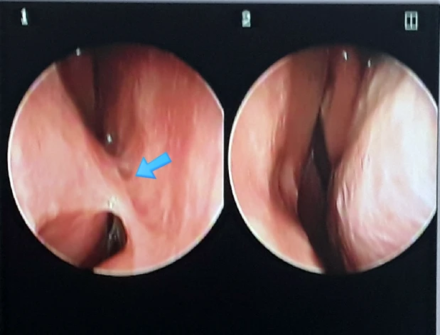 코막힘, 처진코, 비주내리기 코성형 방법 — 본문 사진 4