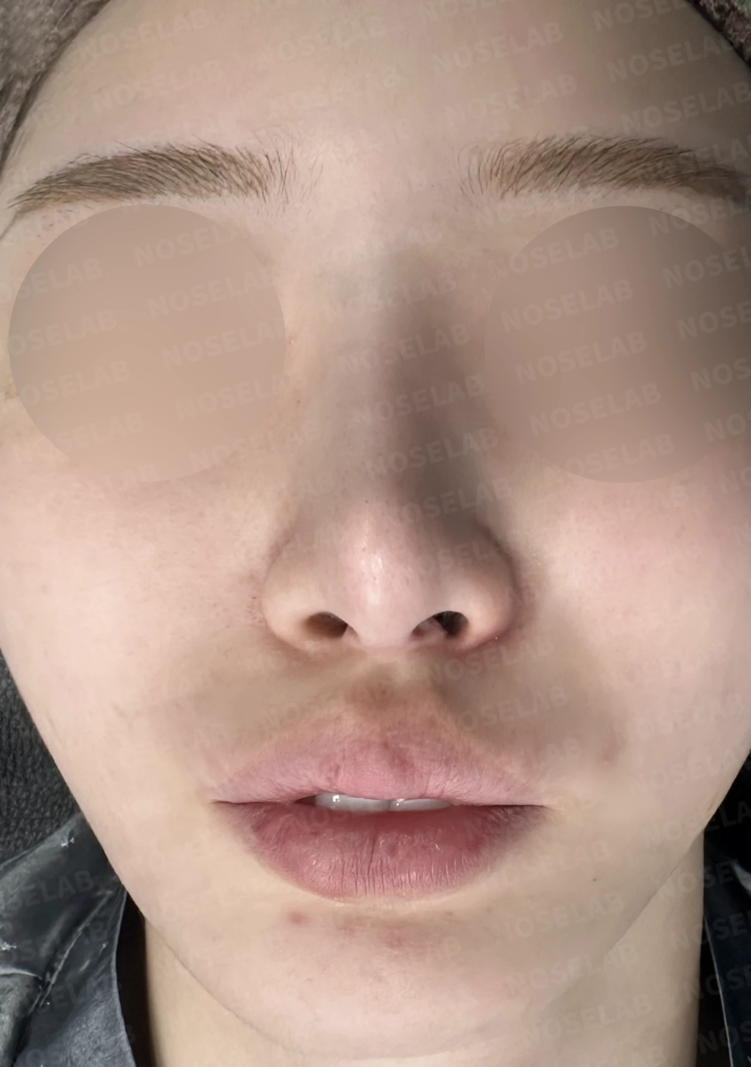 비중격이 심하게 휘고 손상되는 이유, 늑연골 재건은 어떻게 하나 — 수술 전 / 수술 직후 0일 직후 사진은 부기가 있는 상태로 최종 결과와 다를 수 있습니다.