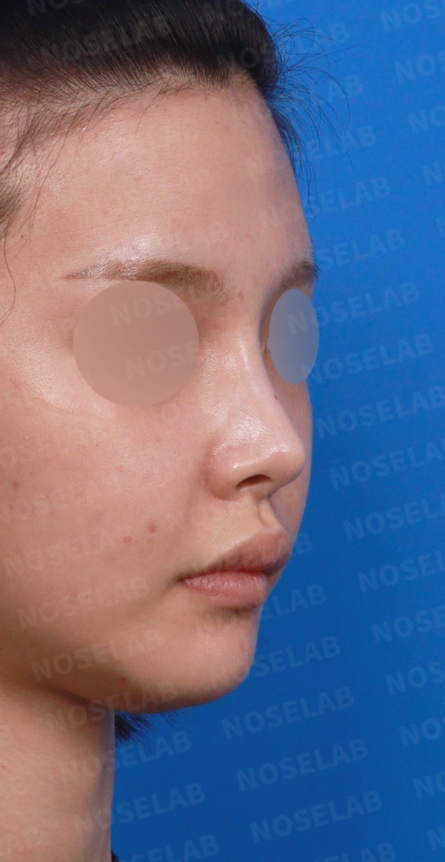 코 시작점이 높고 코끝이 들려 보이는 이유와 교정 방법 — 디자인 상담 우측 측면, 비스듬한 측면, 비공 사진입니다.