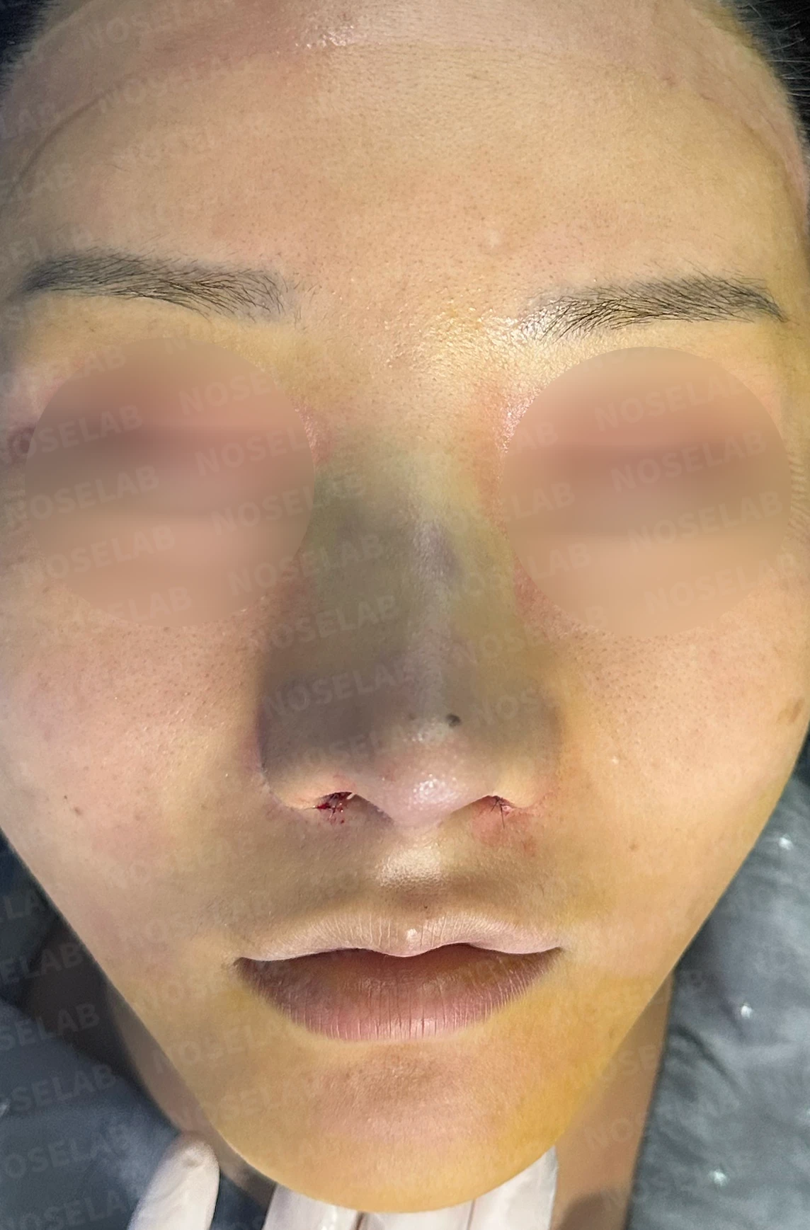 비공 비대칭, 퍼진코! 코재수술 사례 — 전(좌) 직후(우)