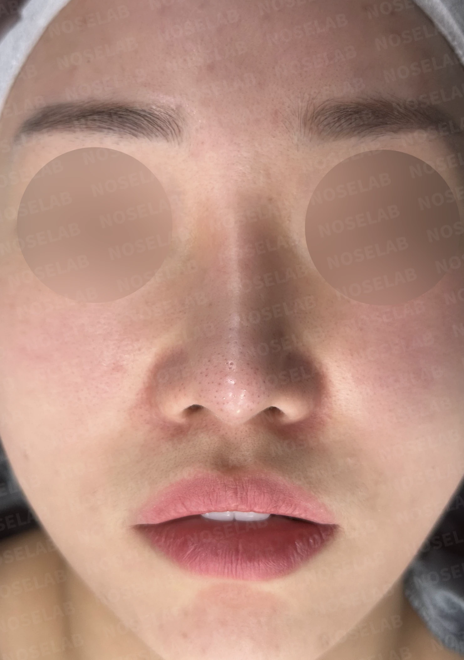 화살코와 복코가 함께 있는 코, 비중격 재건부터 시작하는 이유 — 수술 전 / 수술 직후 0일 직후 사진은 부기가 있는 상태로 최종 결과와 다를 수 있습니다.