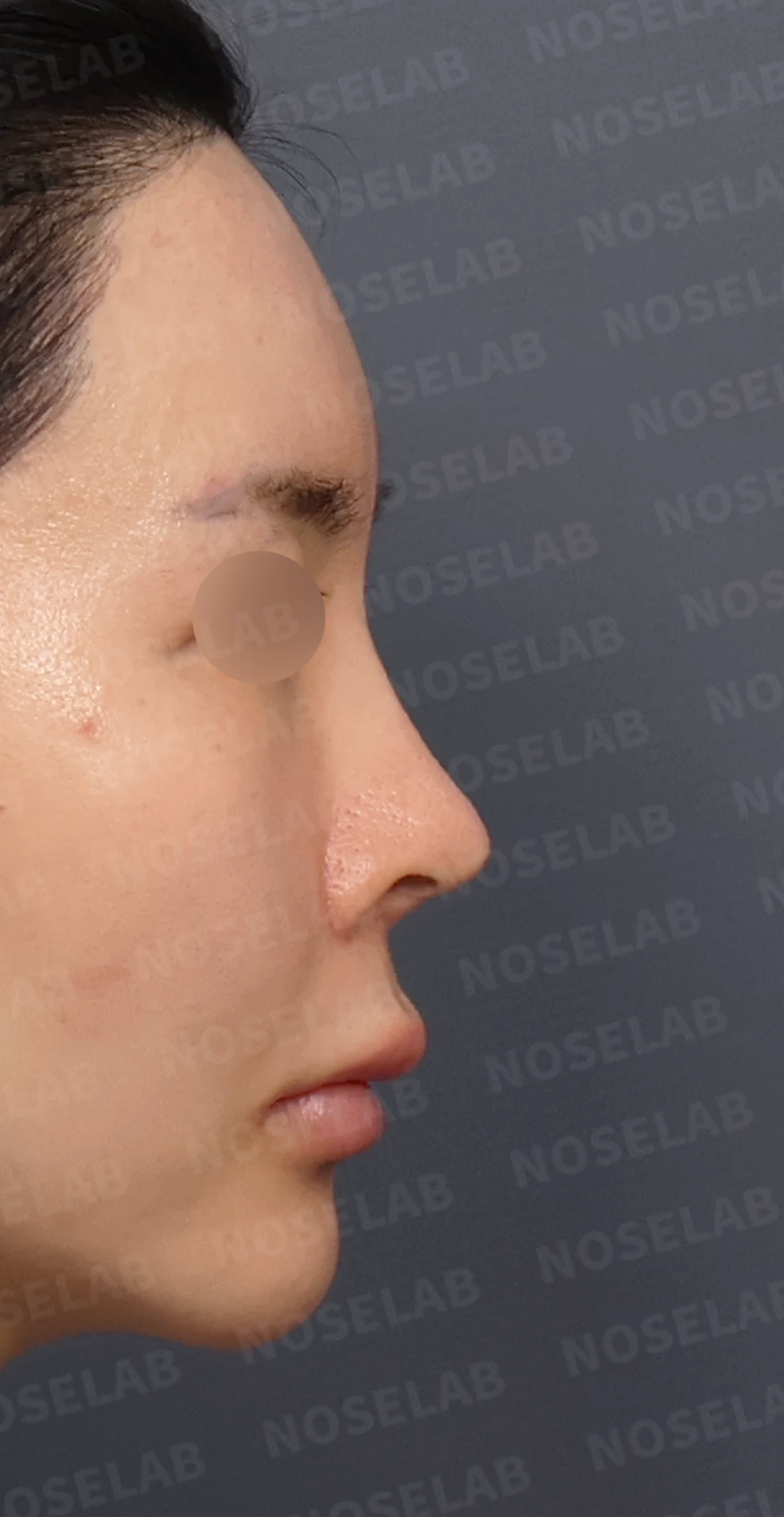 여러 차례 수술 뒤 코막힘이 남는 이유, 비중격과 비밸브 재건은 어떻게 하나 — 디자인 상담 정면, 좌측 측면, 비스듬한 측면 사진입니다.