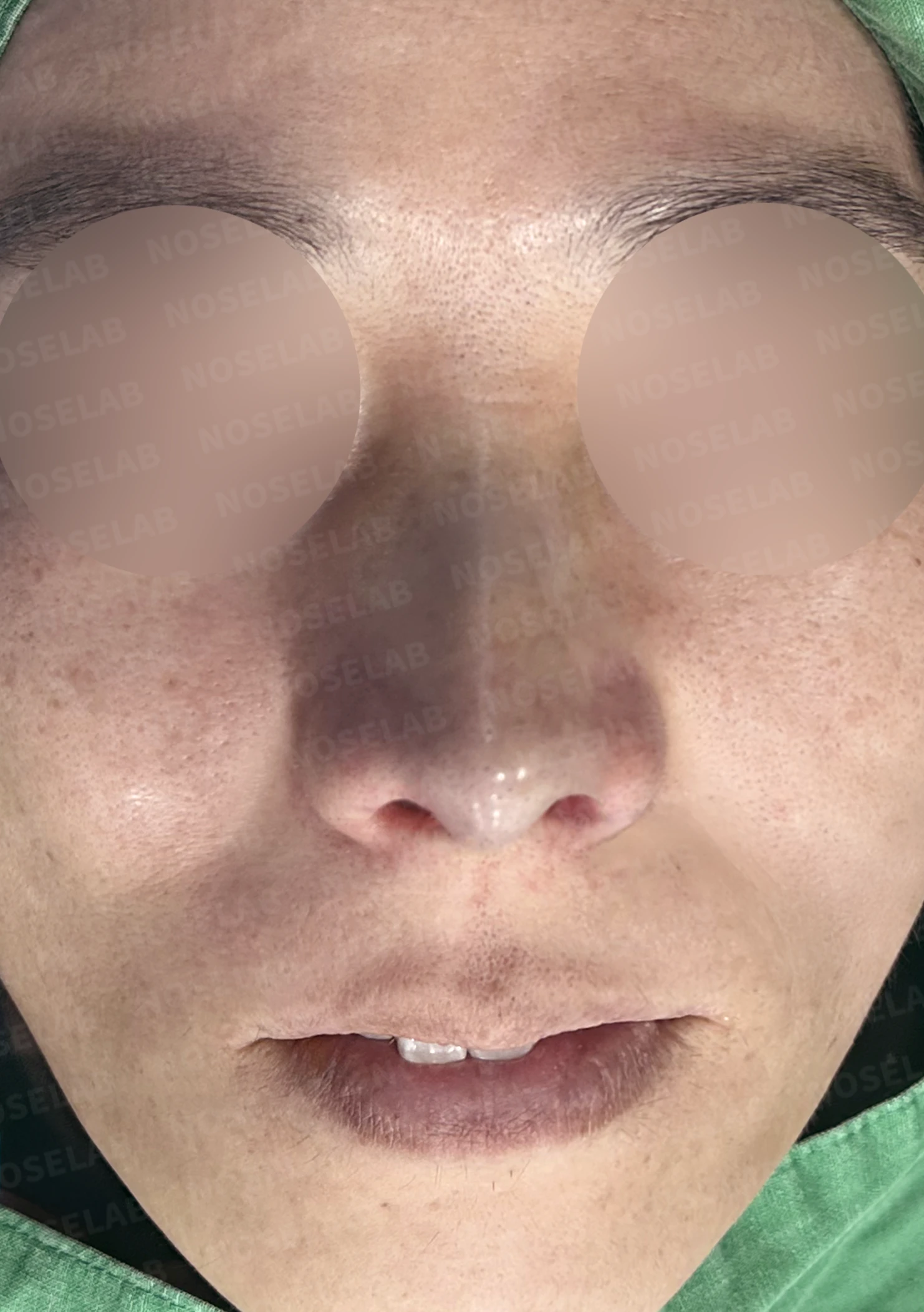 짧고 들린 코와 긴 인중, 자가늑연골로 완성한 남성스러운 직선코 — 전(좌) 직후(후)